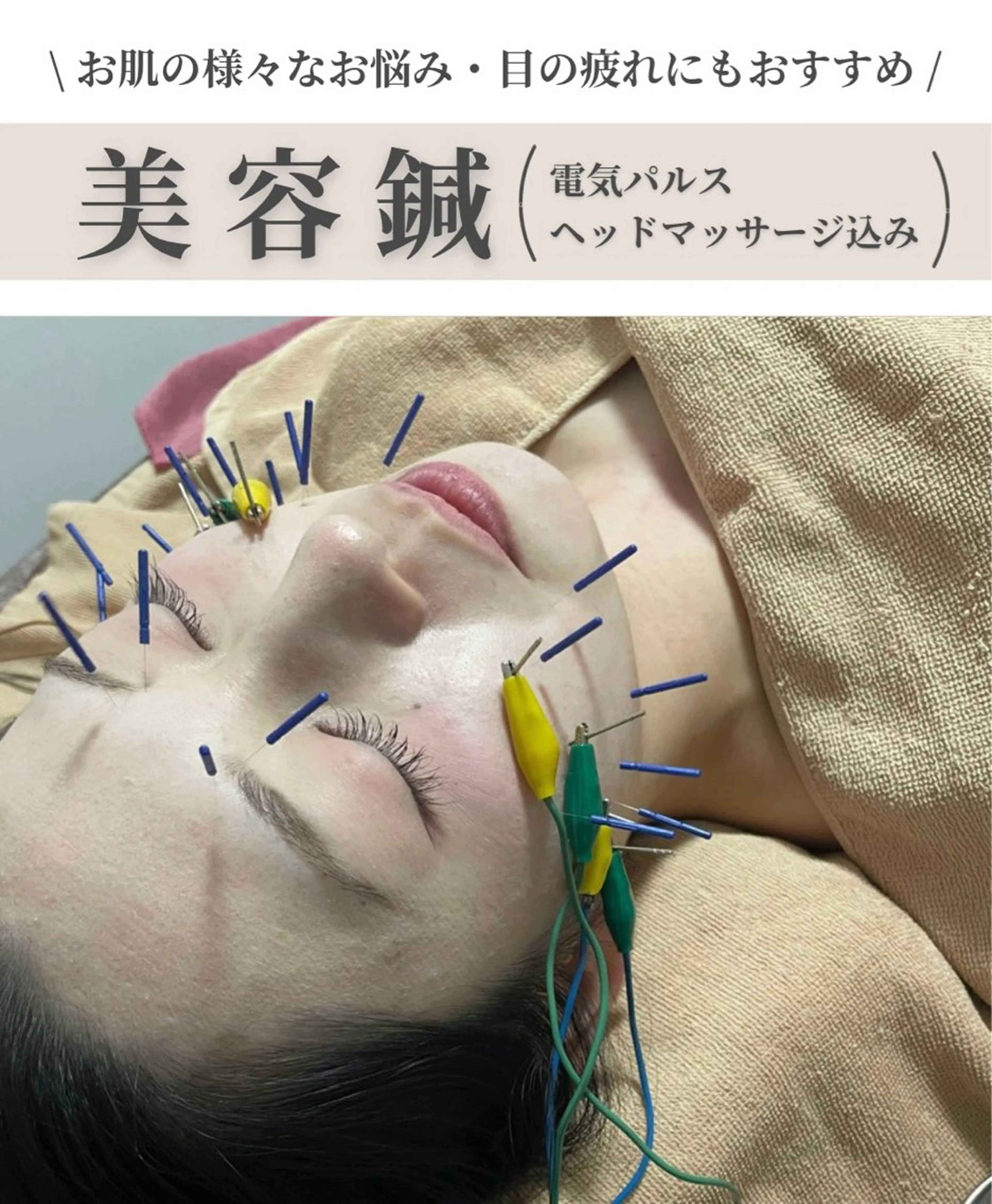 \ 人気No.2 / 美容鍼➕ヘッドマッサージ 【プレミアムコース】の写真