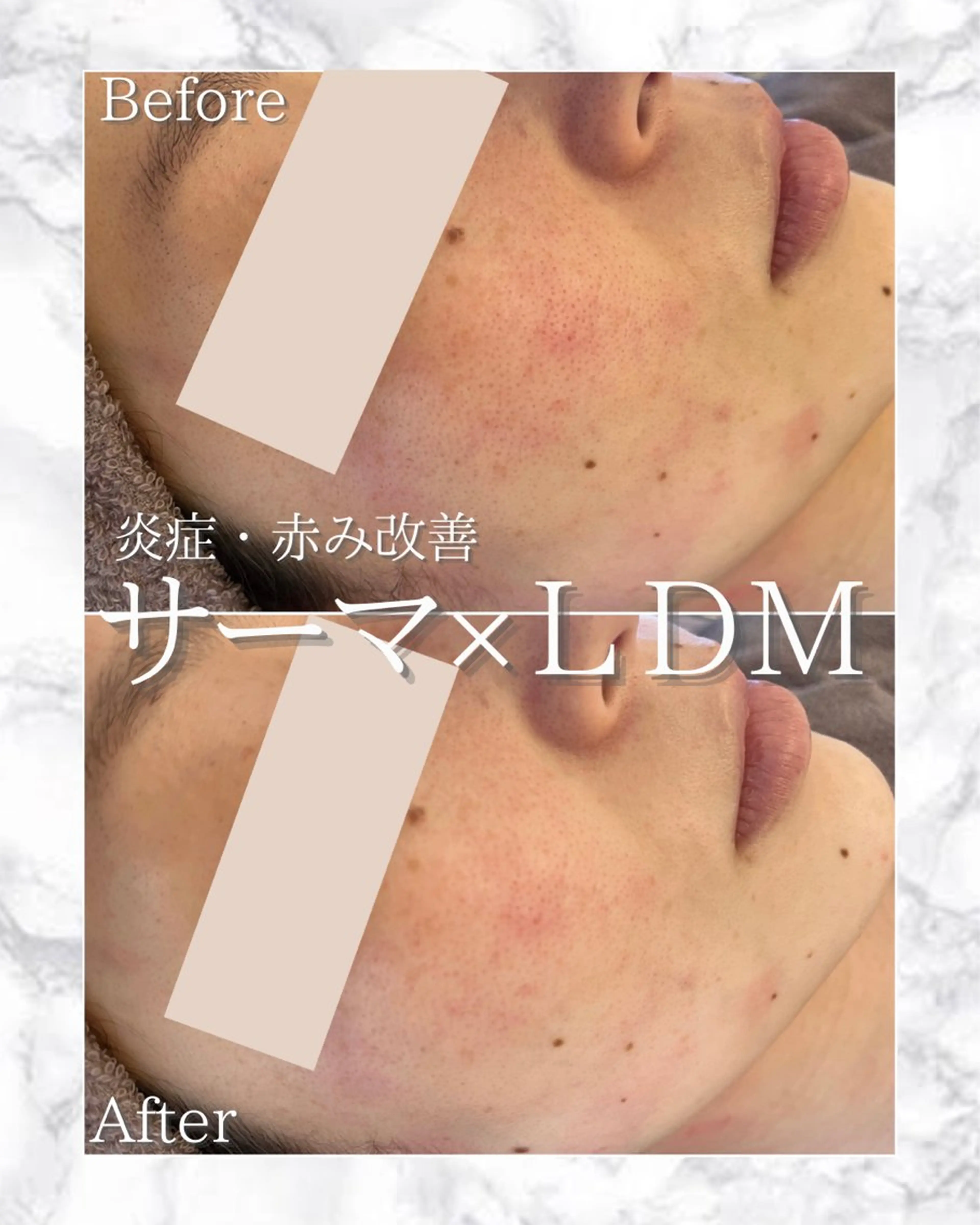 💆♀️最強たるみケア🔥サーマトリックス900shot+水玉リフティングLDM🫧or選べる美容液アクアダーマ導入❕の写真