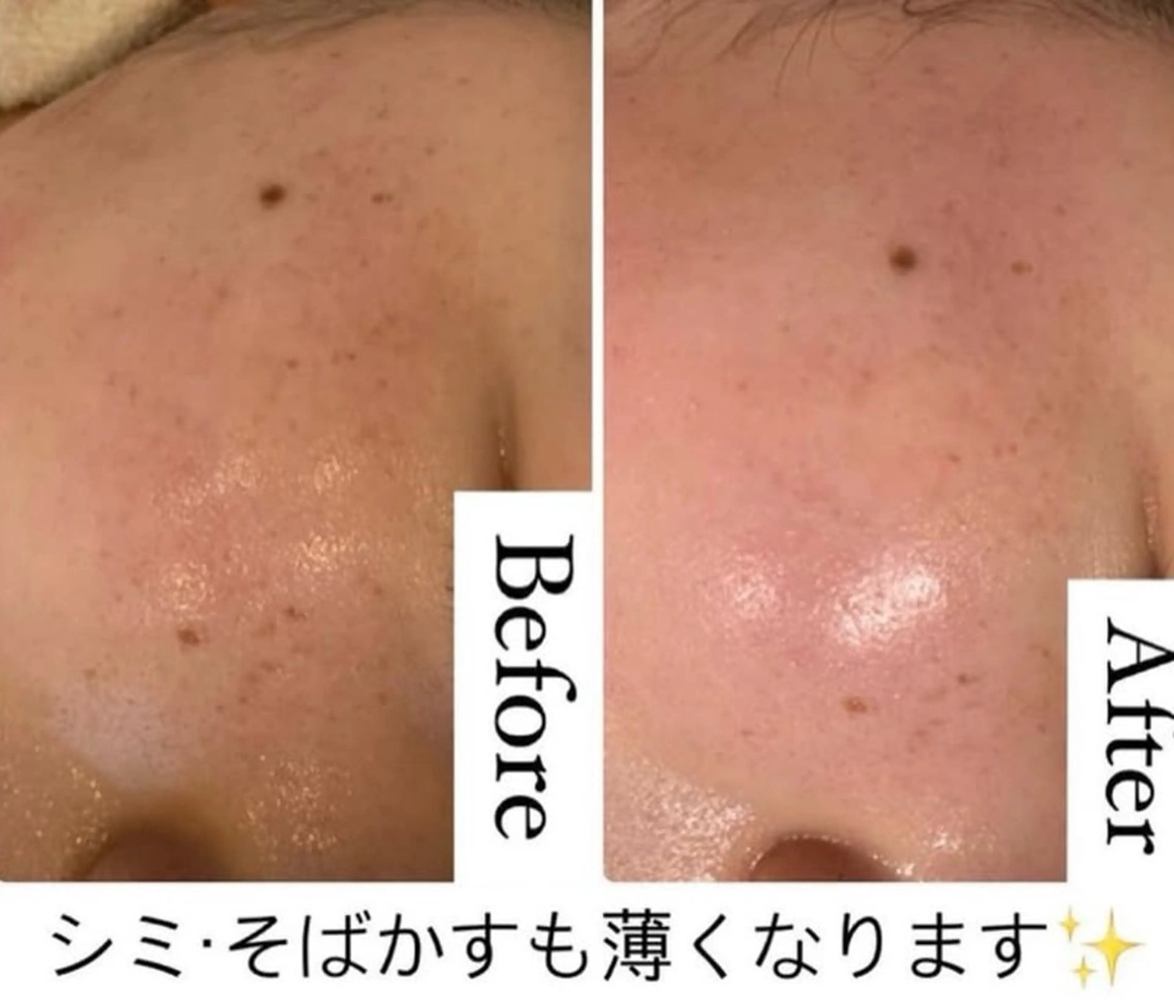 ❤️ツヤハリ+透明肌💖ハイドラ毛穴洗浄全顔+高濃度VC導入+コルギ+デコルテ首肩+美肌LED 💚 60分¥3990の写真