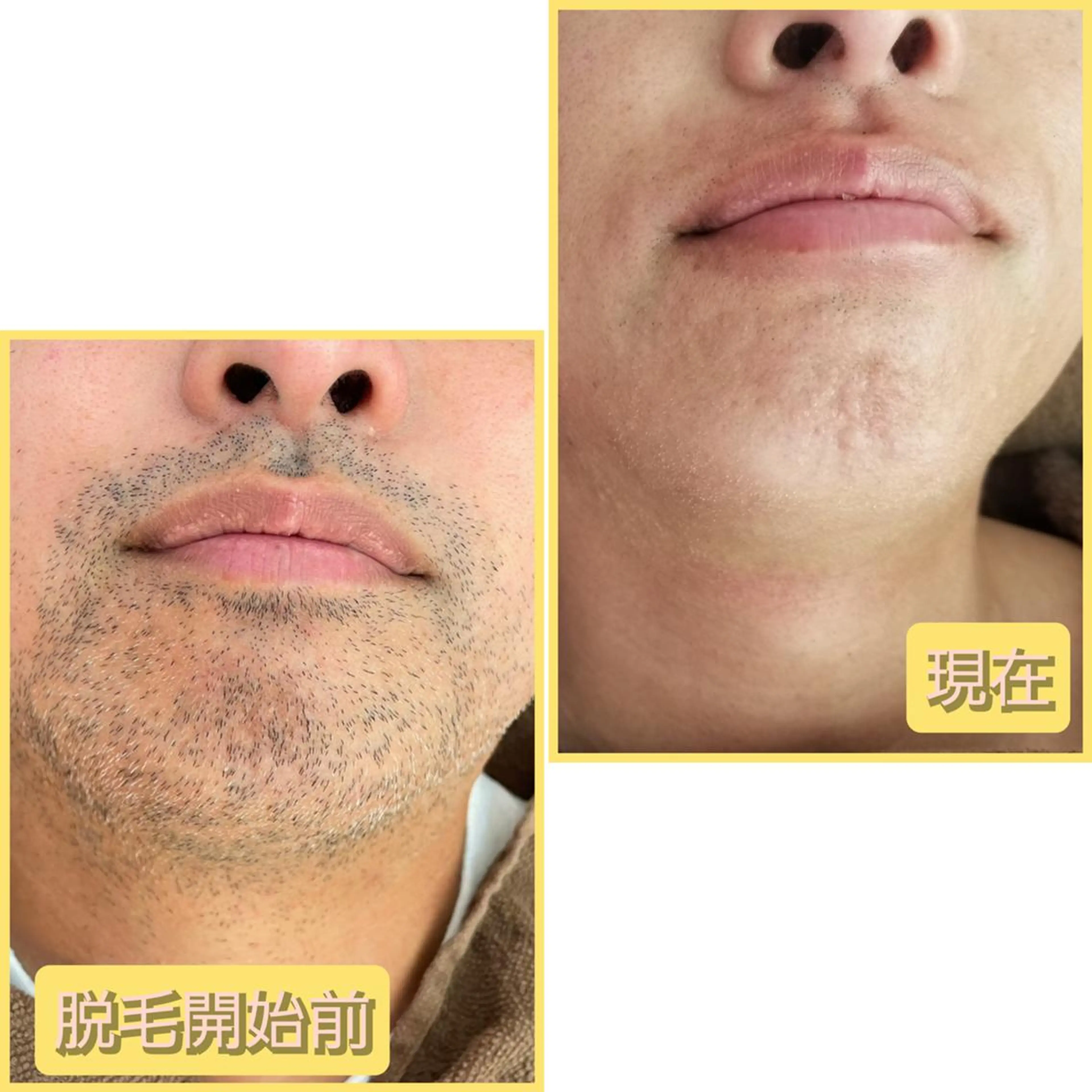 メンズ👨ヒゲ脱毛🪒の写真