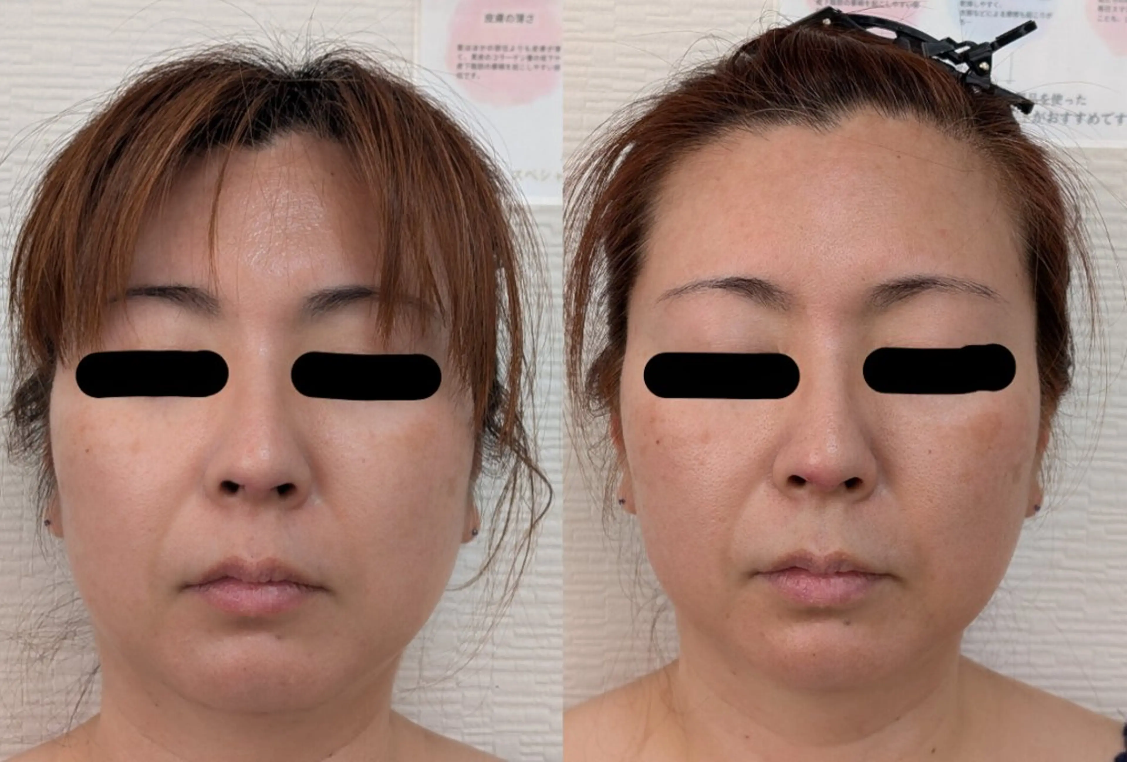 エステ 〈ニキビケアサロン〉 レゾン京橋店/ 浅川のエステ・リラクイメージ