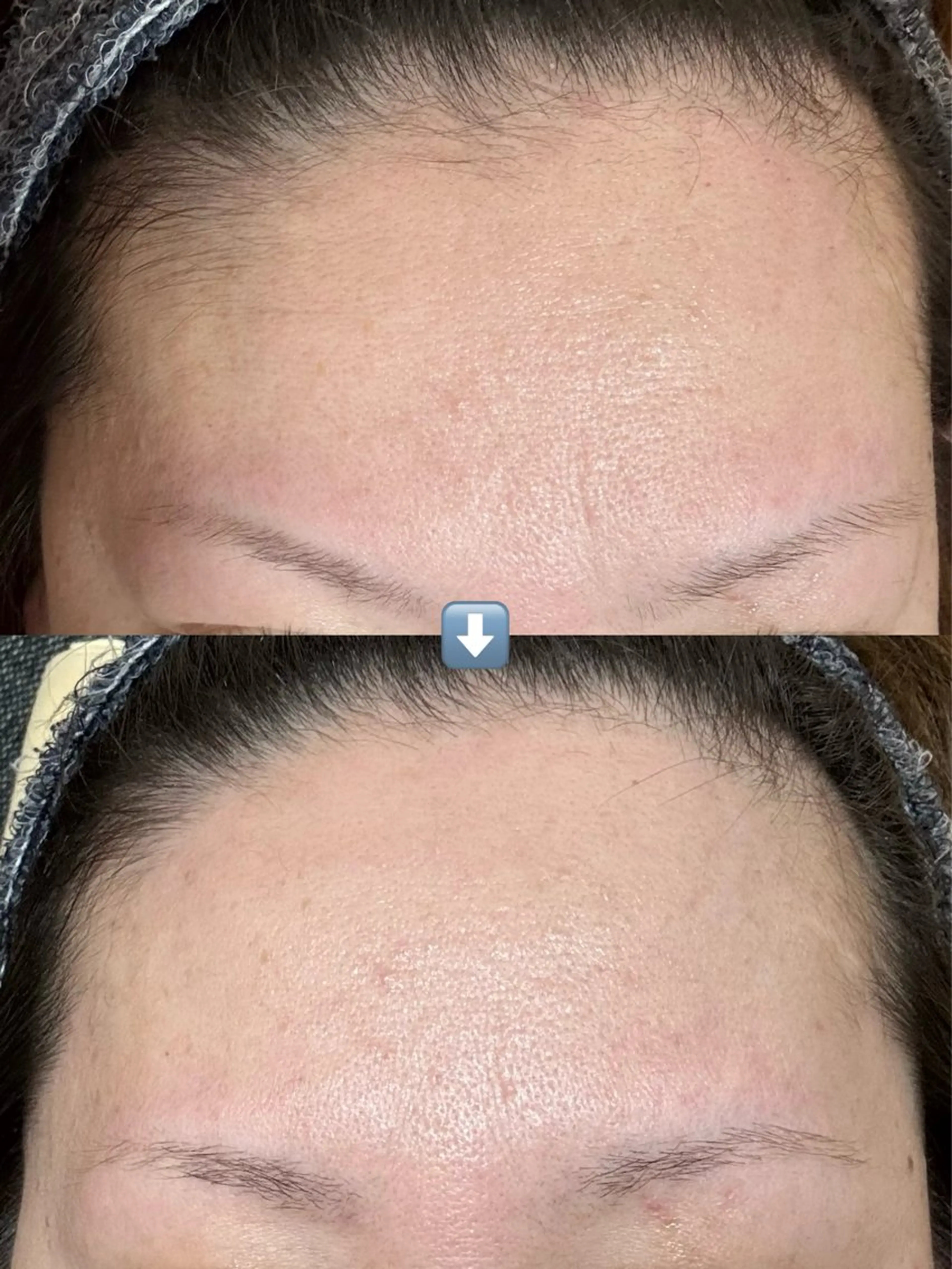 【新メニュー】気になる人にはキニナル産毛WAX脱毛❕限定価格 ¥2000円 (前髪生え際産毛のみ）の写真