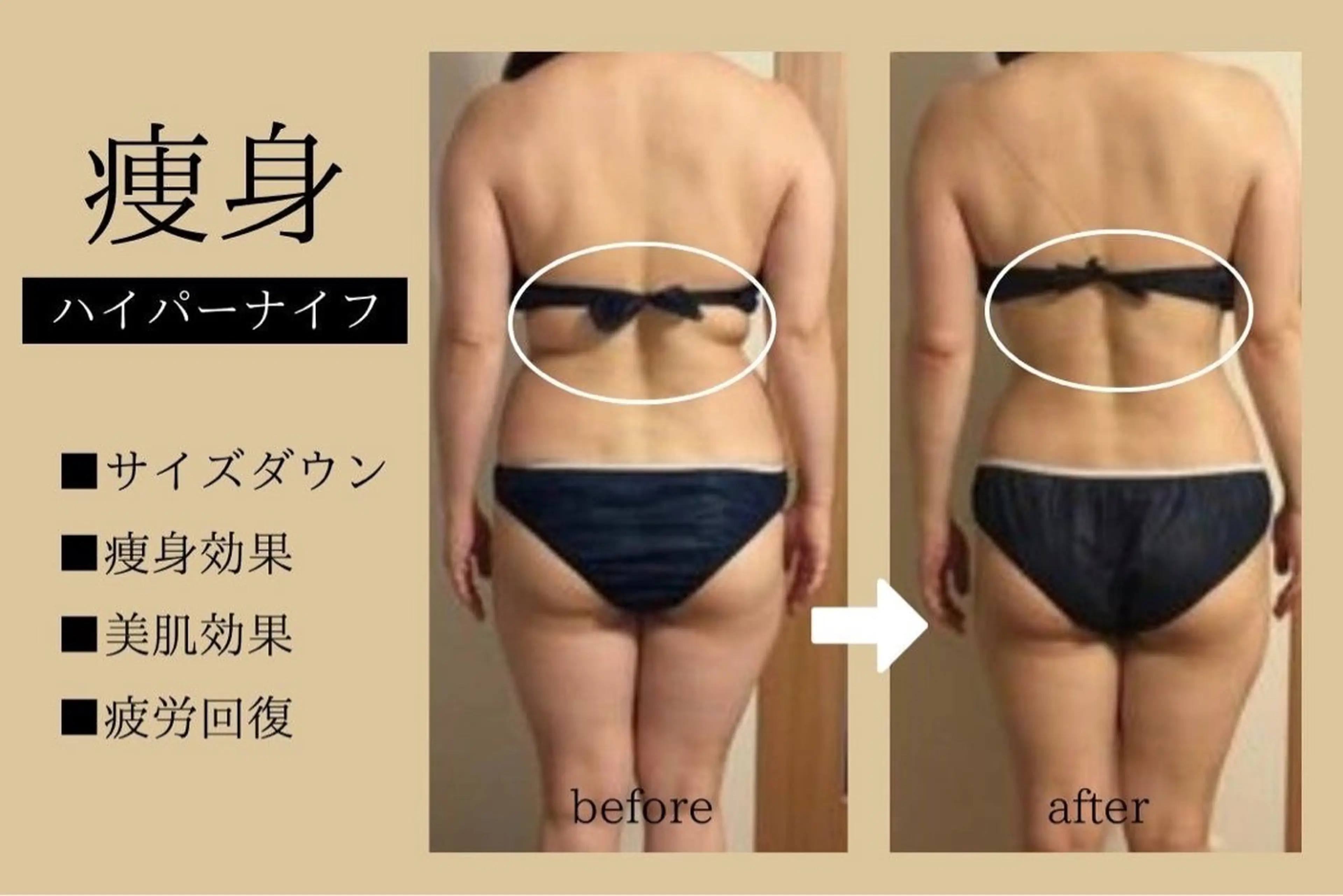 ≪特価★お腹二の腕背中≫ハイパーナイフ+ マッサージ60分¥ 13000→ ¥ 6800の写真