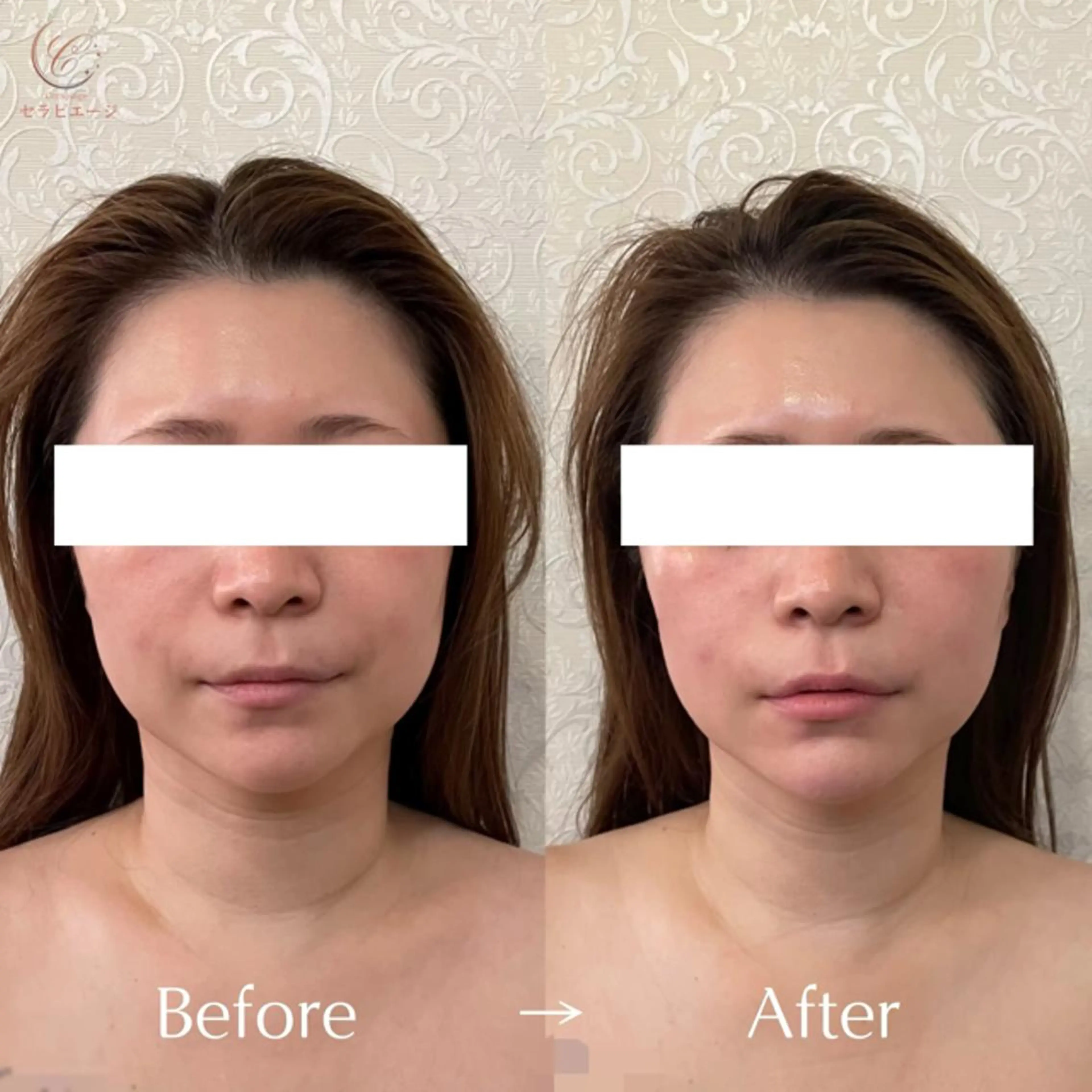 エステ 小顔/毛穴/肌質改善 💆セラピエージのエステ・リラクイメージ