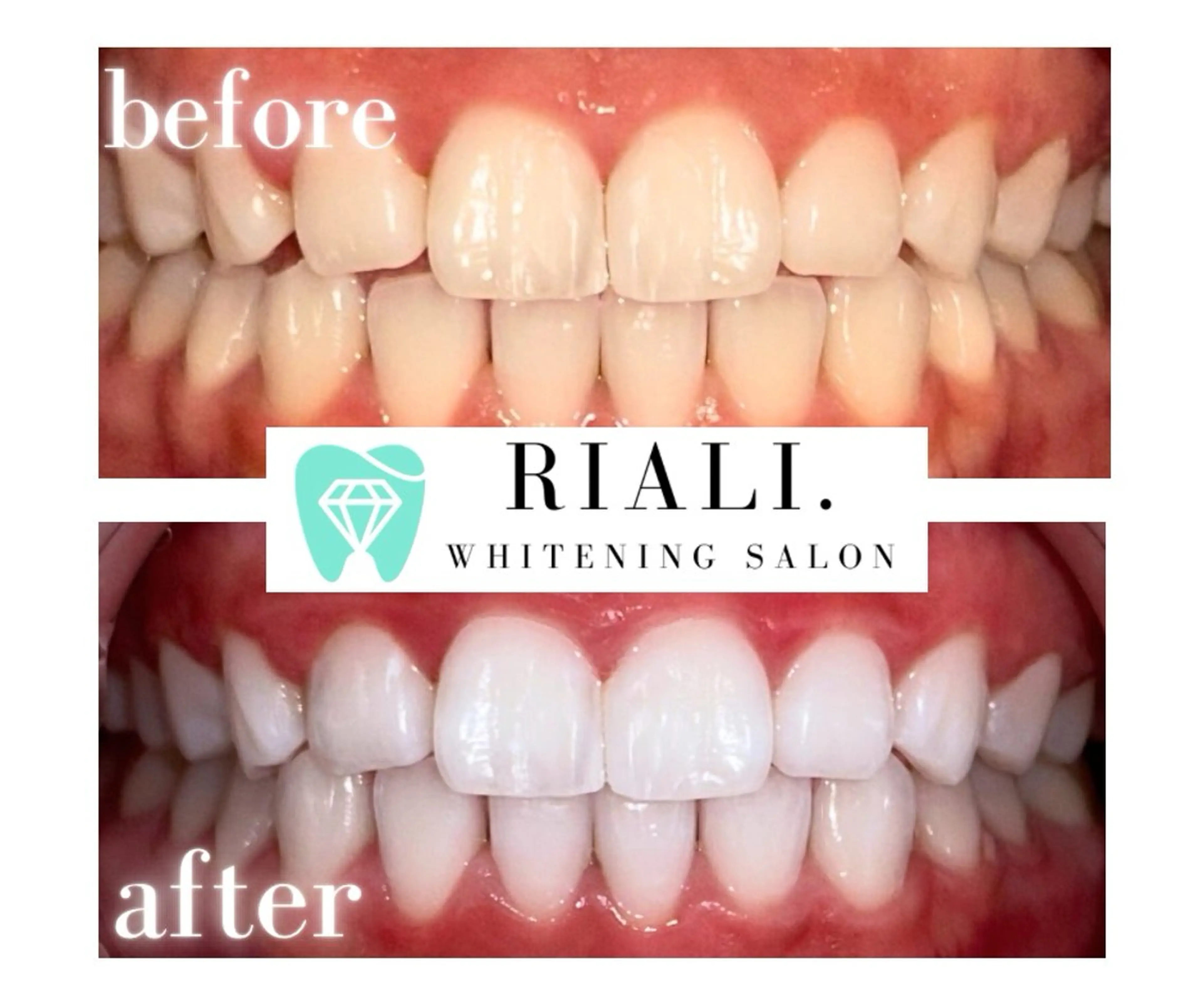 最高級プラチナセルフホワイトニング40分照射の写真