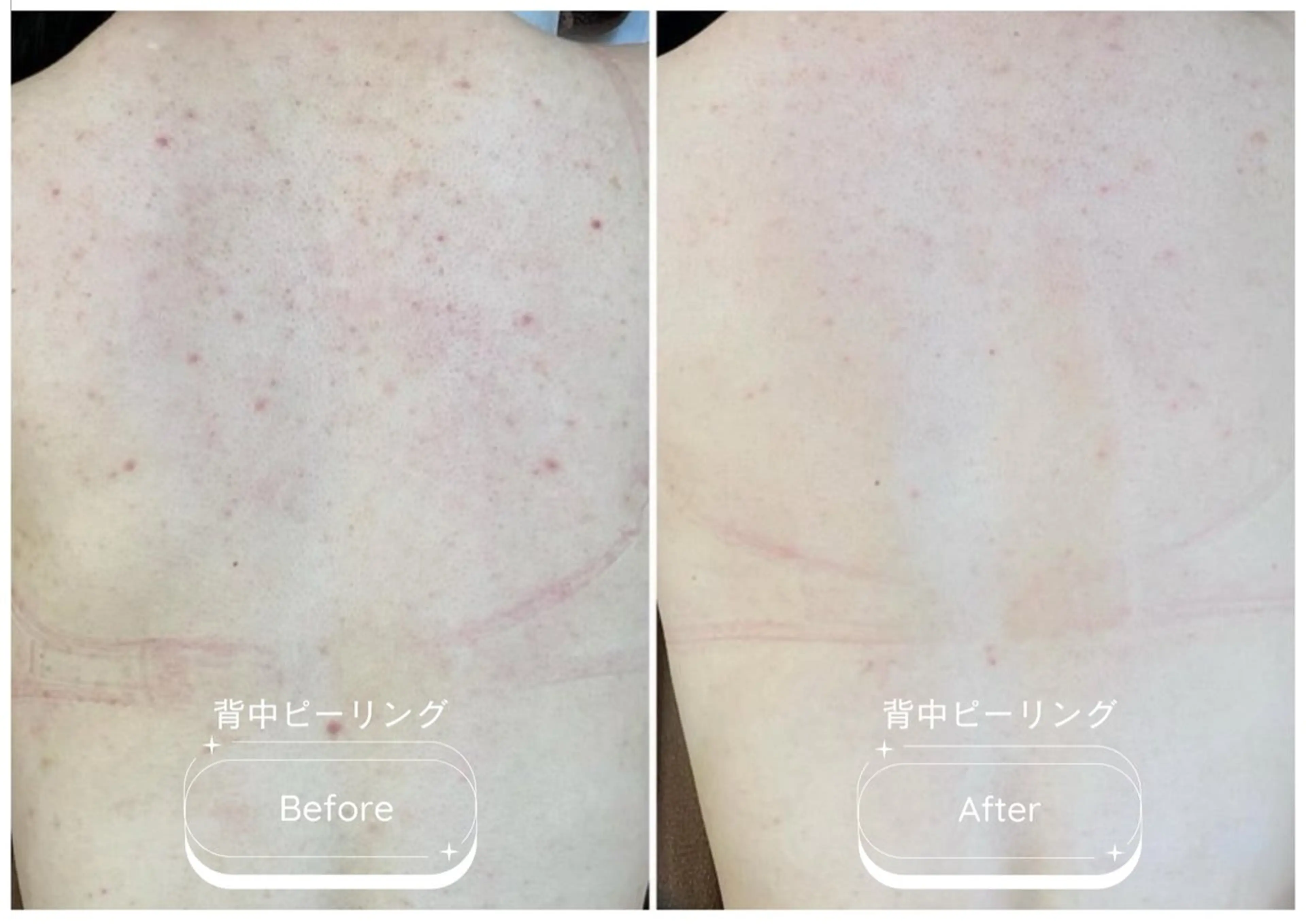 モニター募集🪡背中全体<7日間改善プログラム>剥離有ピーリング◎1週間で背中つるつる🫧ニキビ跡/ニキビ/色素沈着の写真