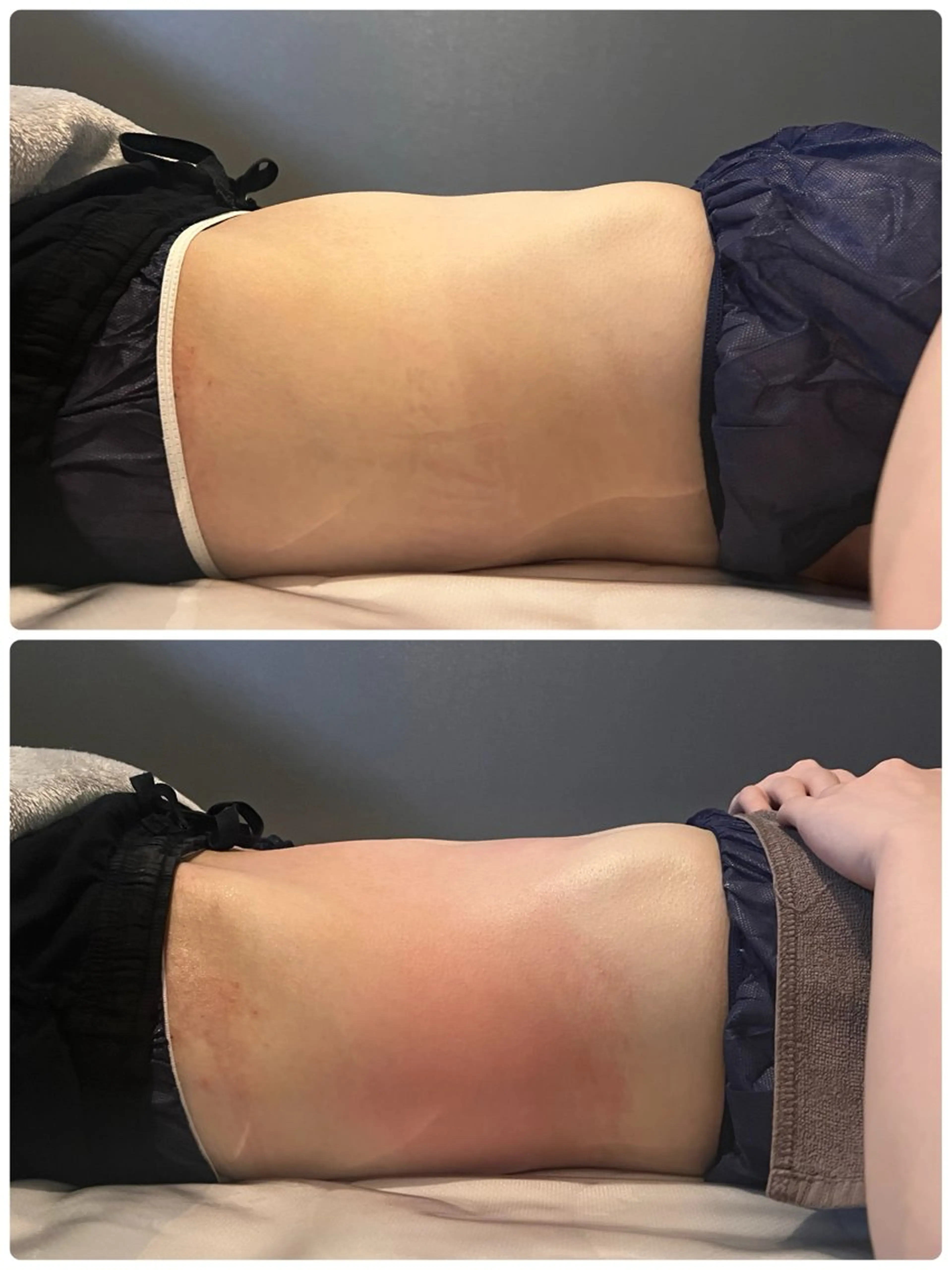 《新ボディ夏までに急げ💨》ハイパーナイフ＆マッサージ付きの写真