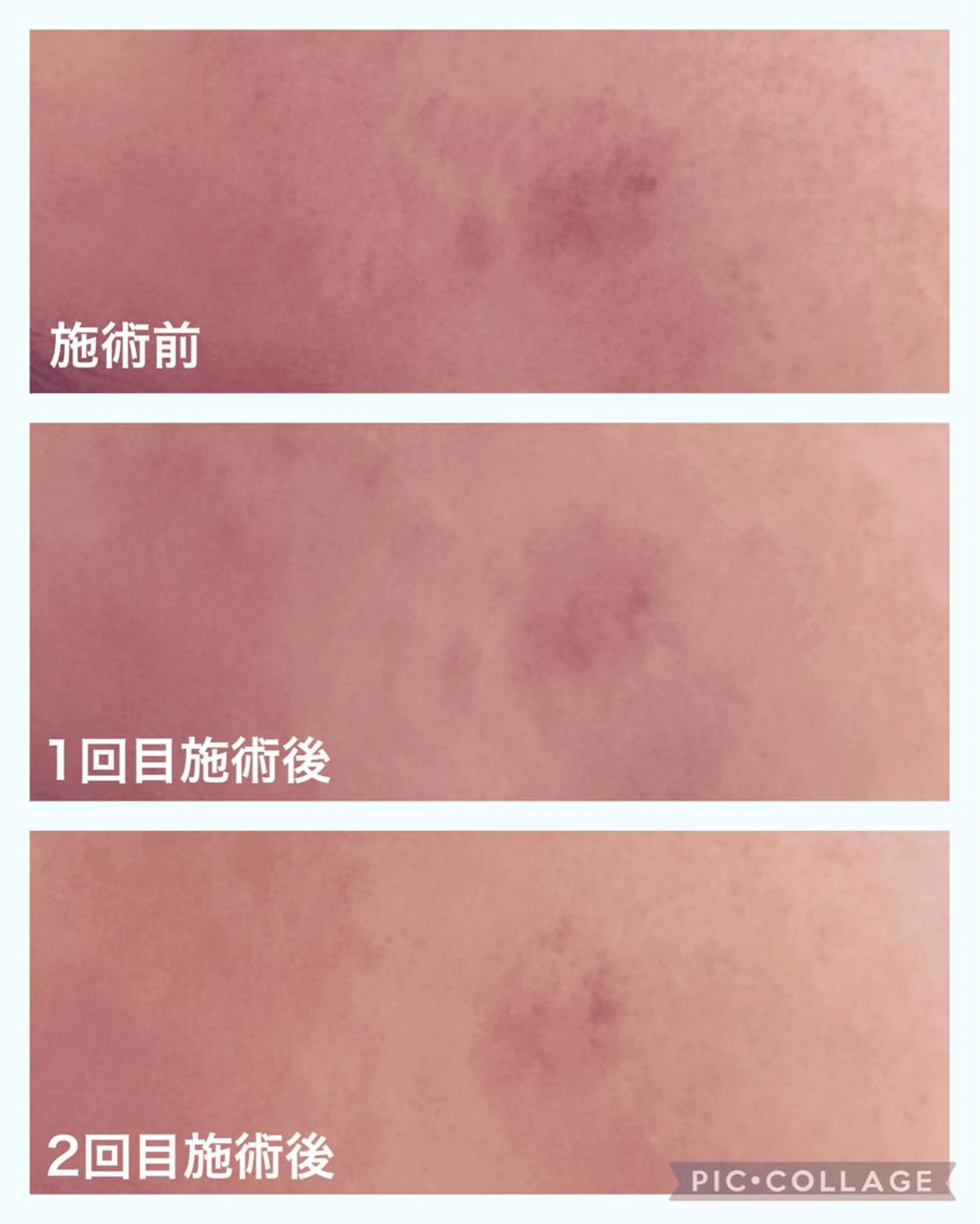 医療レベルの美容機器　グロッティしみケアコースの写真