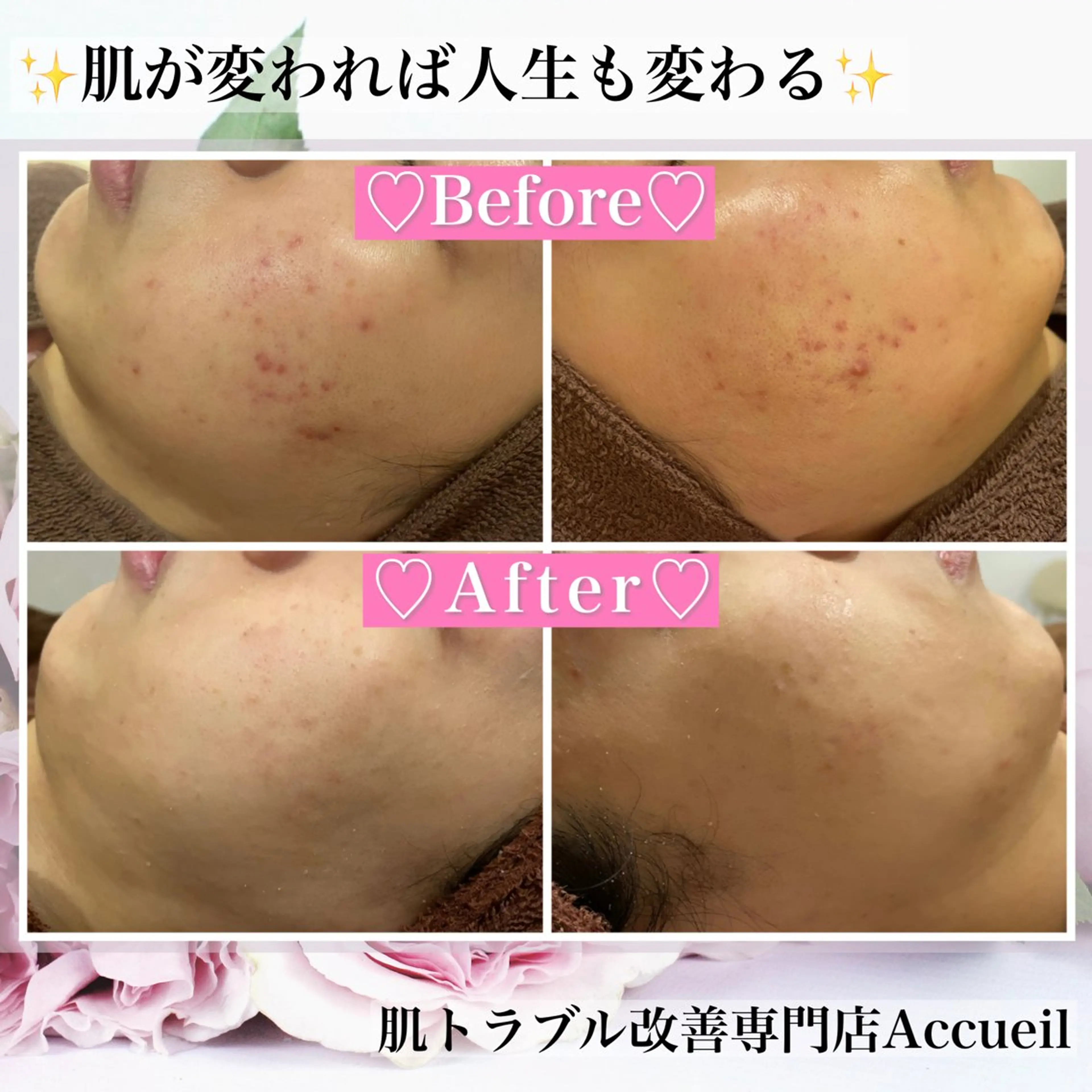 エステ リラク ニキビ・肌質改善専門 ♡人生が変わるサロンのエステ・リラクイメージ