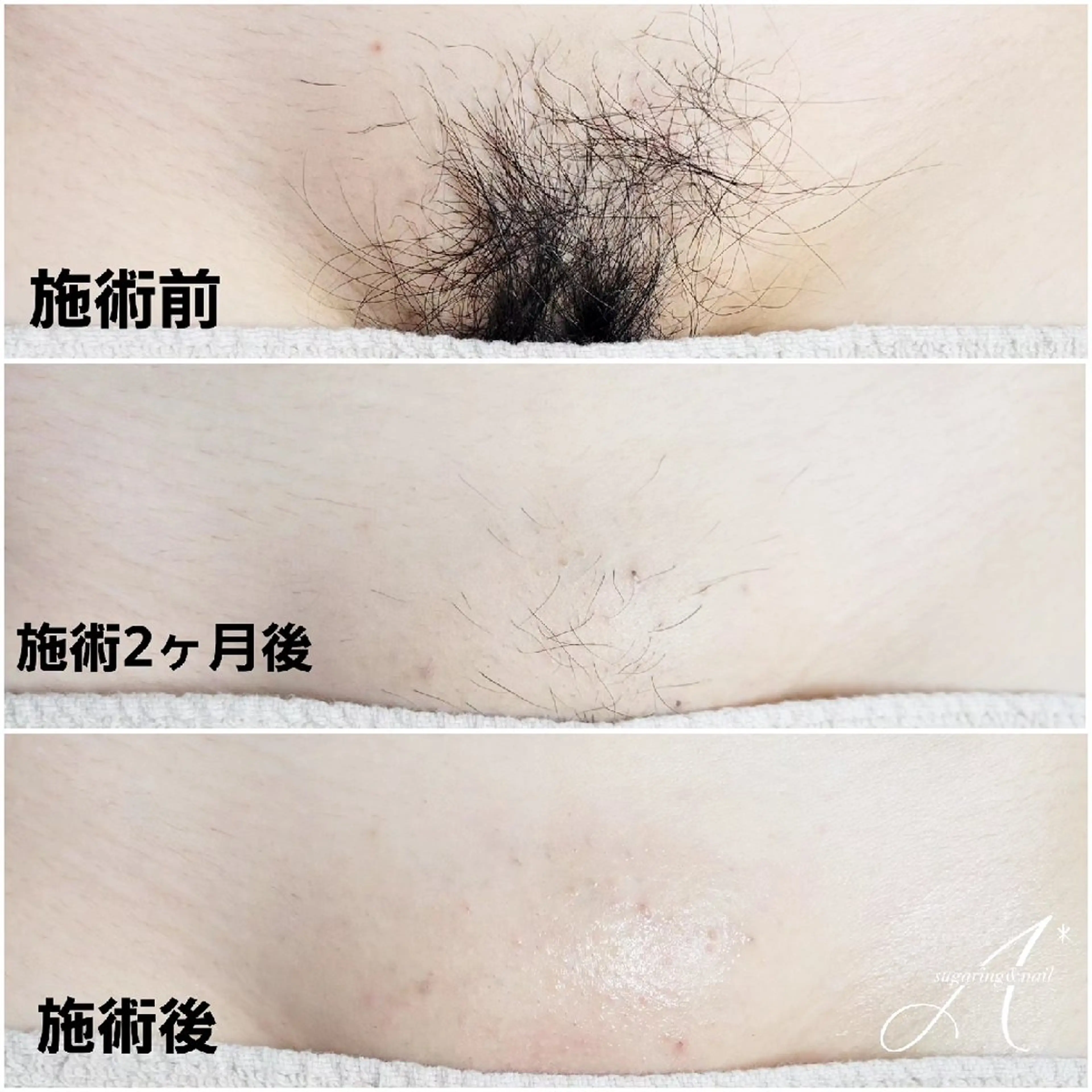 A*《エースター》 シュガーリング🍋のエステ・リラクイメージ