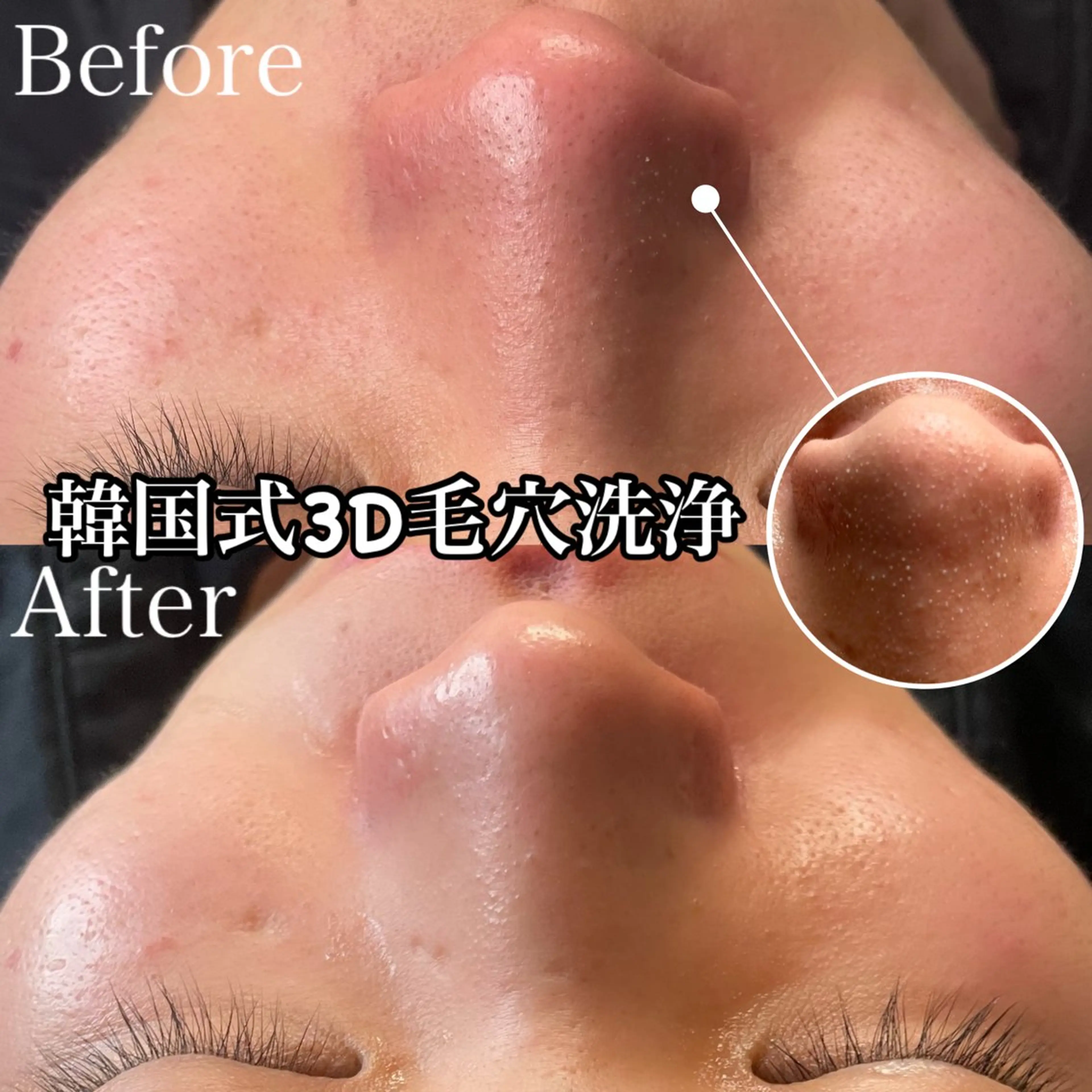 MENS人気No.２韓国式３D毛穴洗浄フェイシャル＋韓国美容液導入の写真
