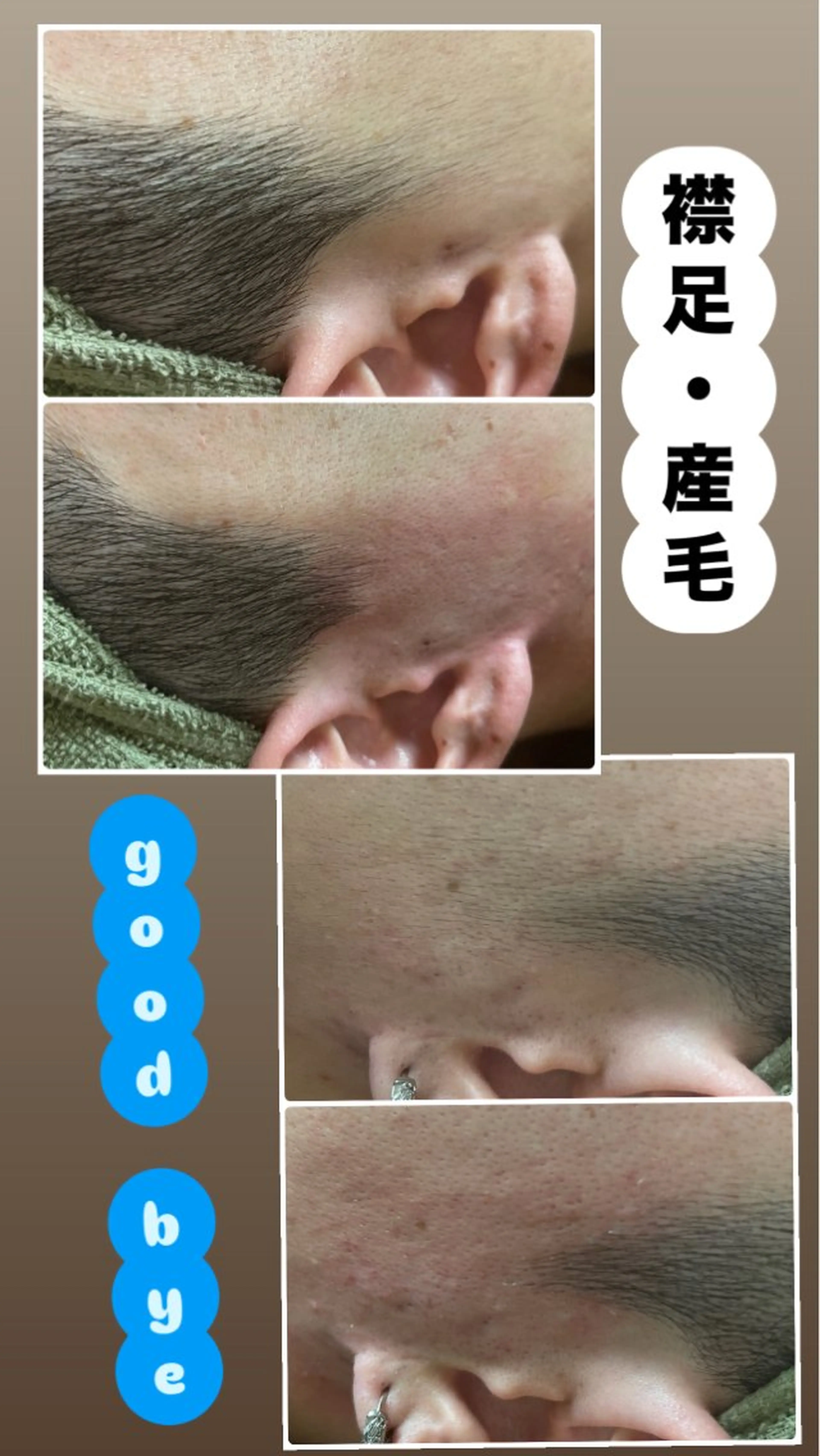顔全体＋もみあげワックス脱毛の写真