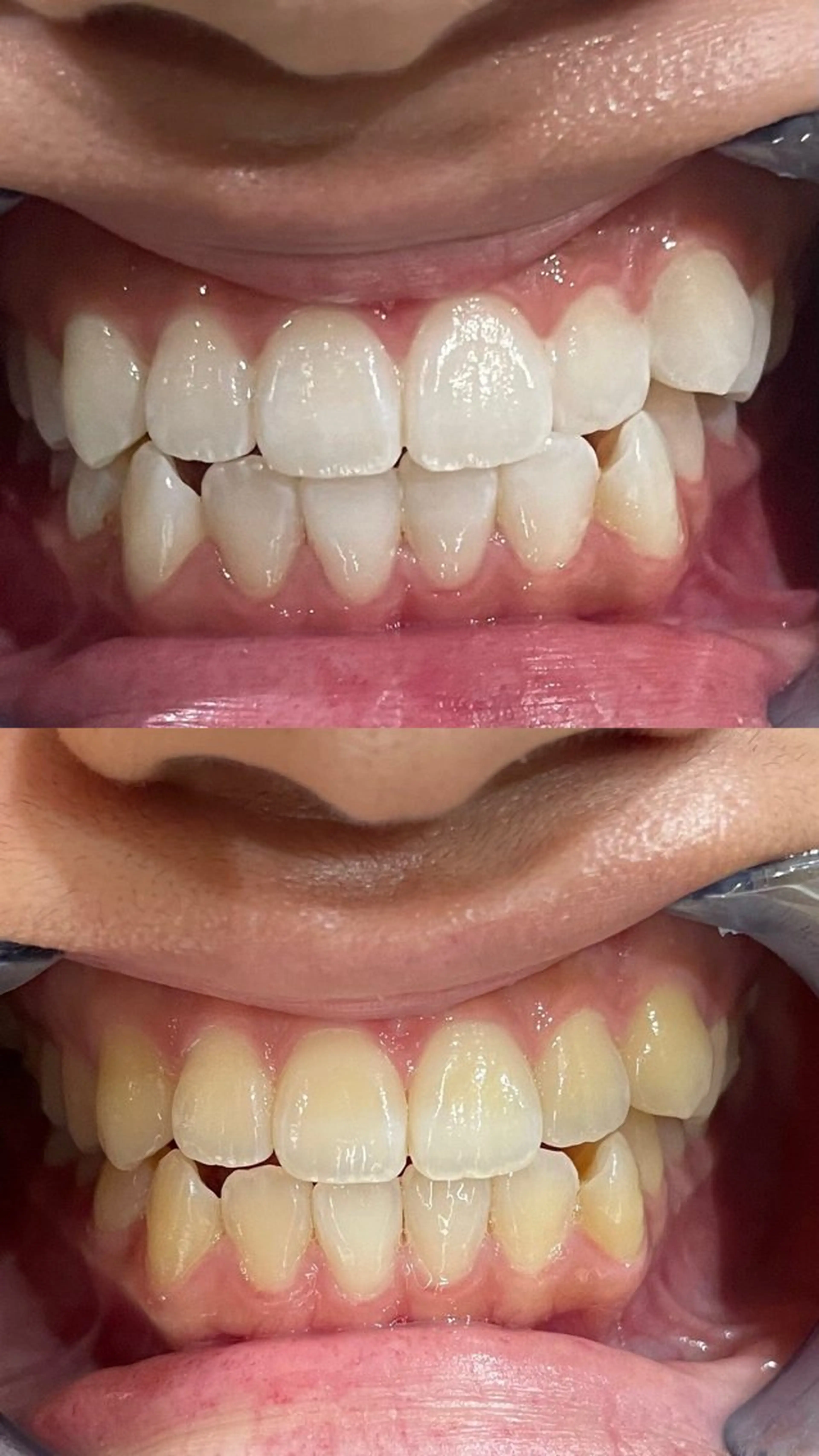 その他 セルフホワイトニング 都立大学🦷✴︎のその他イメージ