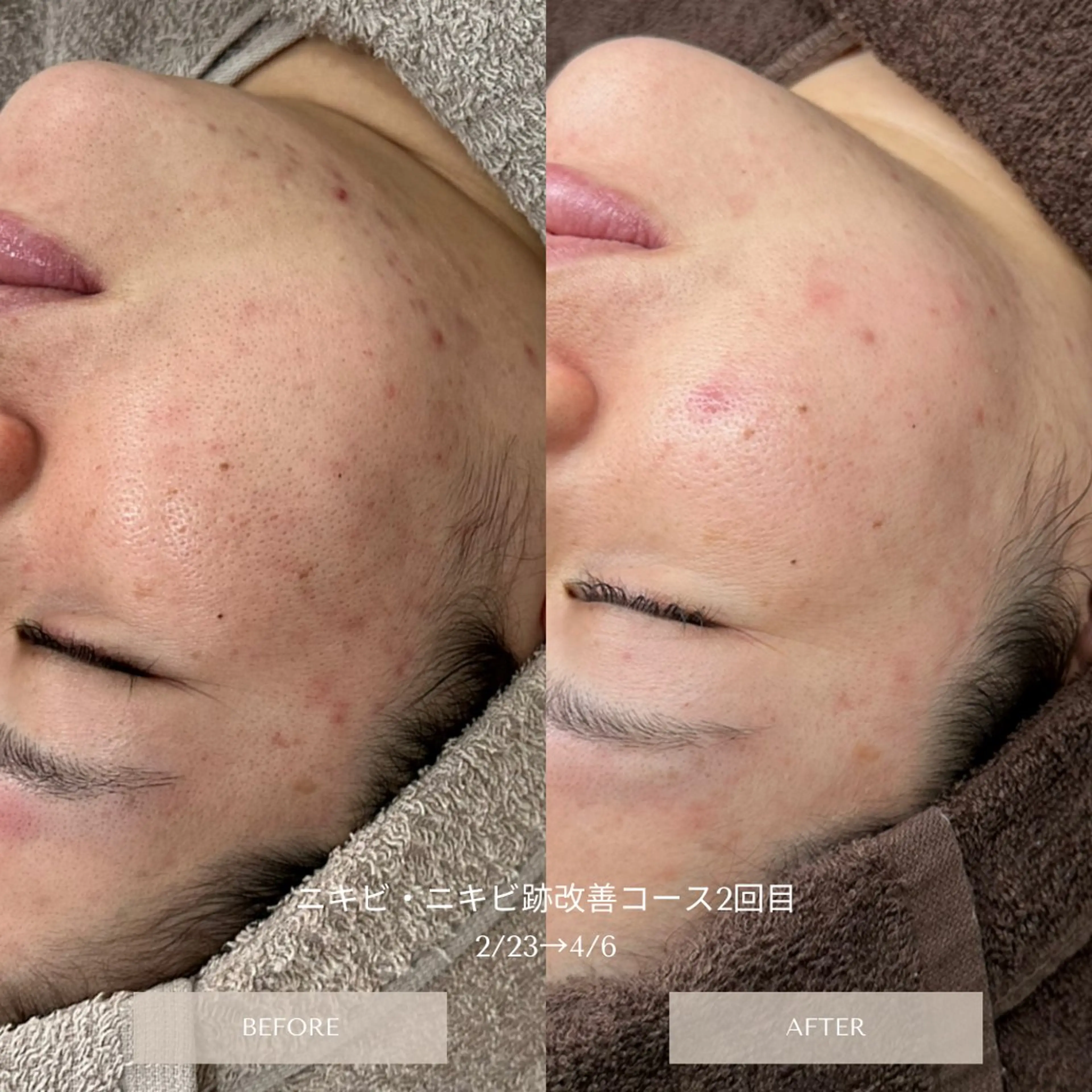 ✨new✨韓国ハーブピーリング🌿ニキビケア！剥離ありタイプの写真