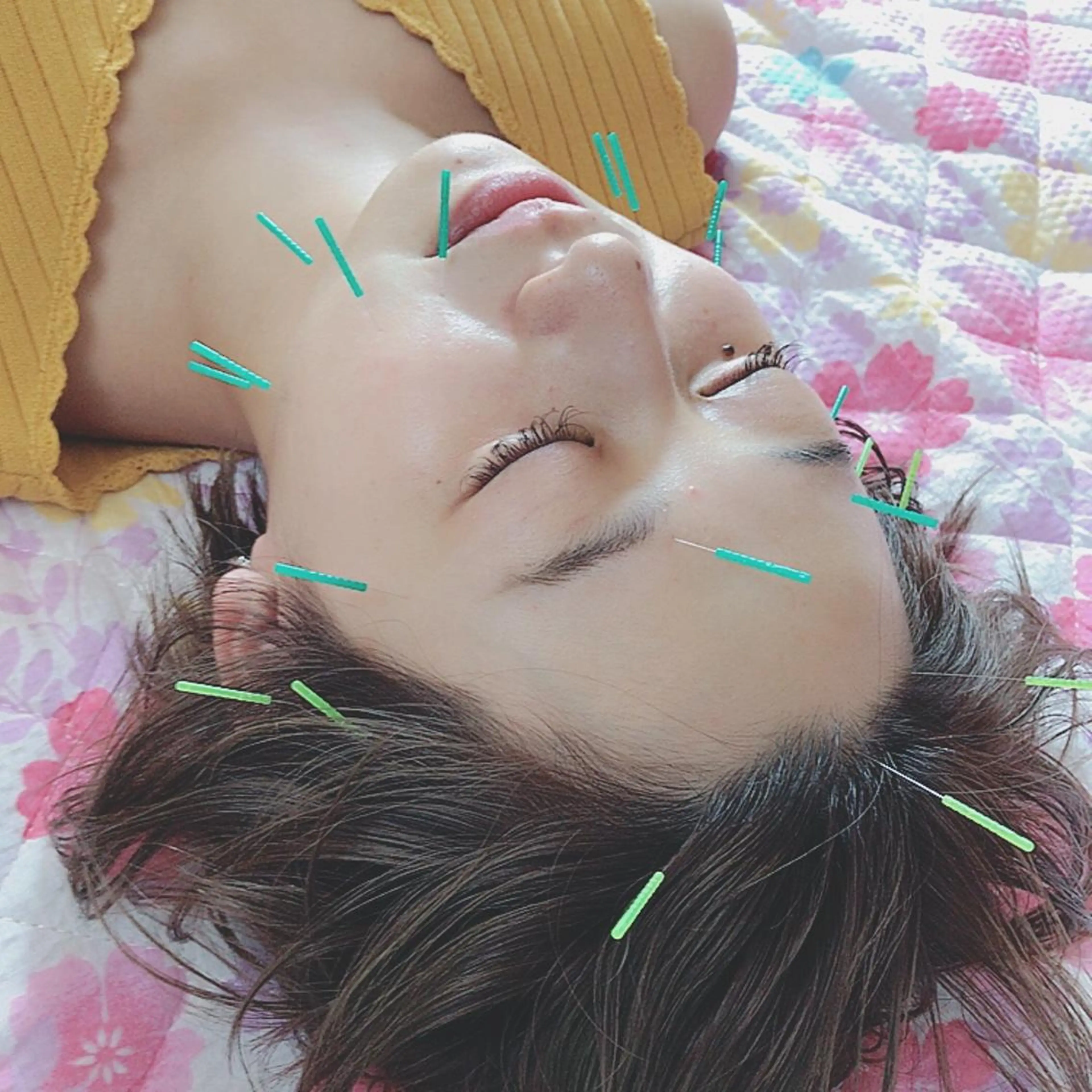 美容鍼のみ(初回)♡minimo限定価格♡の写真