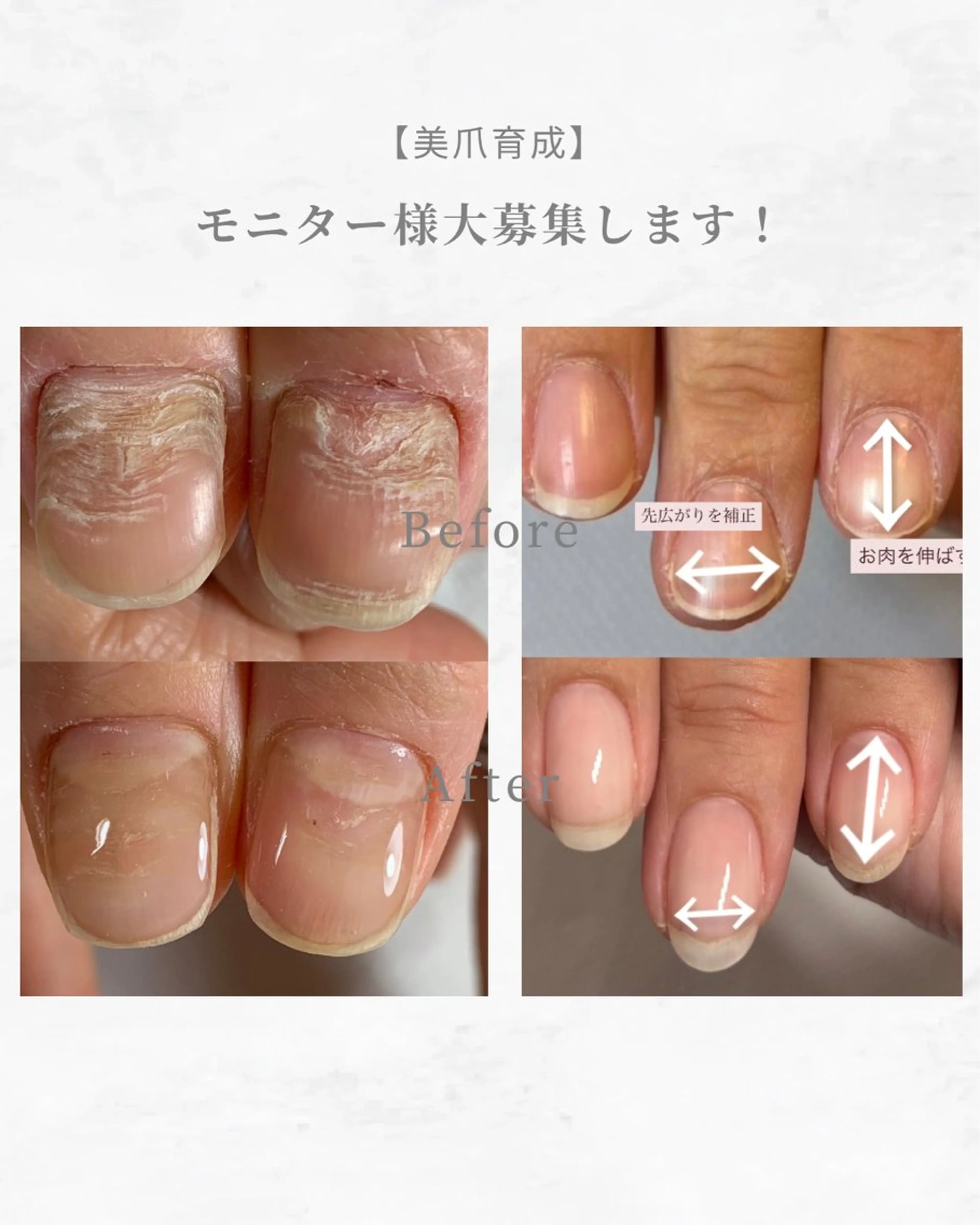 美爪育成【深爪矯正3回通える方】　限定２人まで！の写真