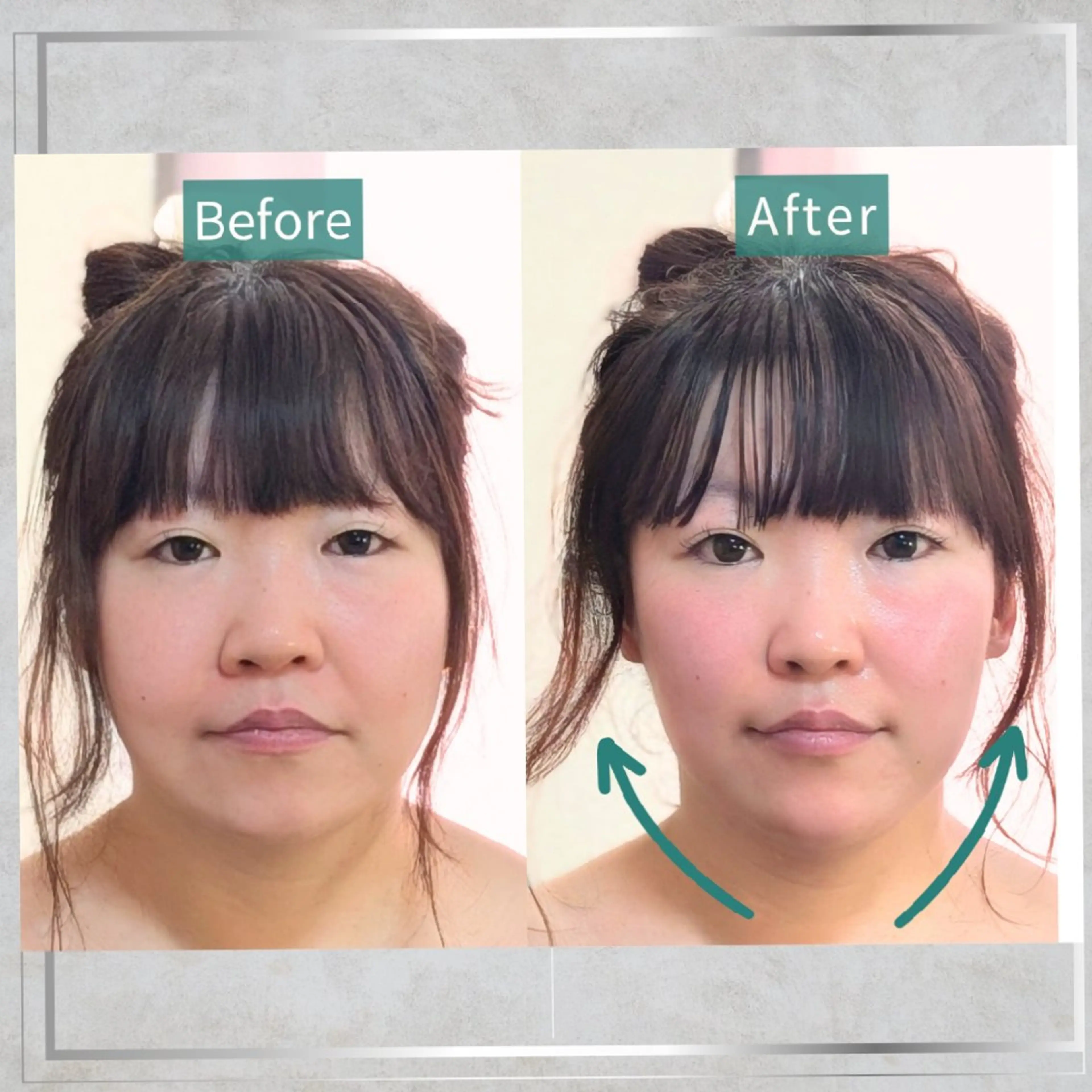 人気No.1【最強小顔】美容鍼/ラジオ波!顔・頬のお肉/脂肪/二重あご改善120分の写真