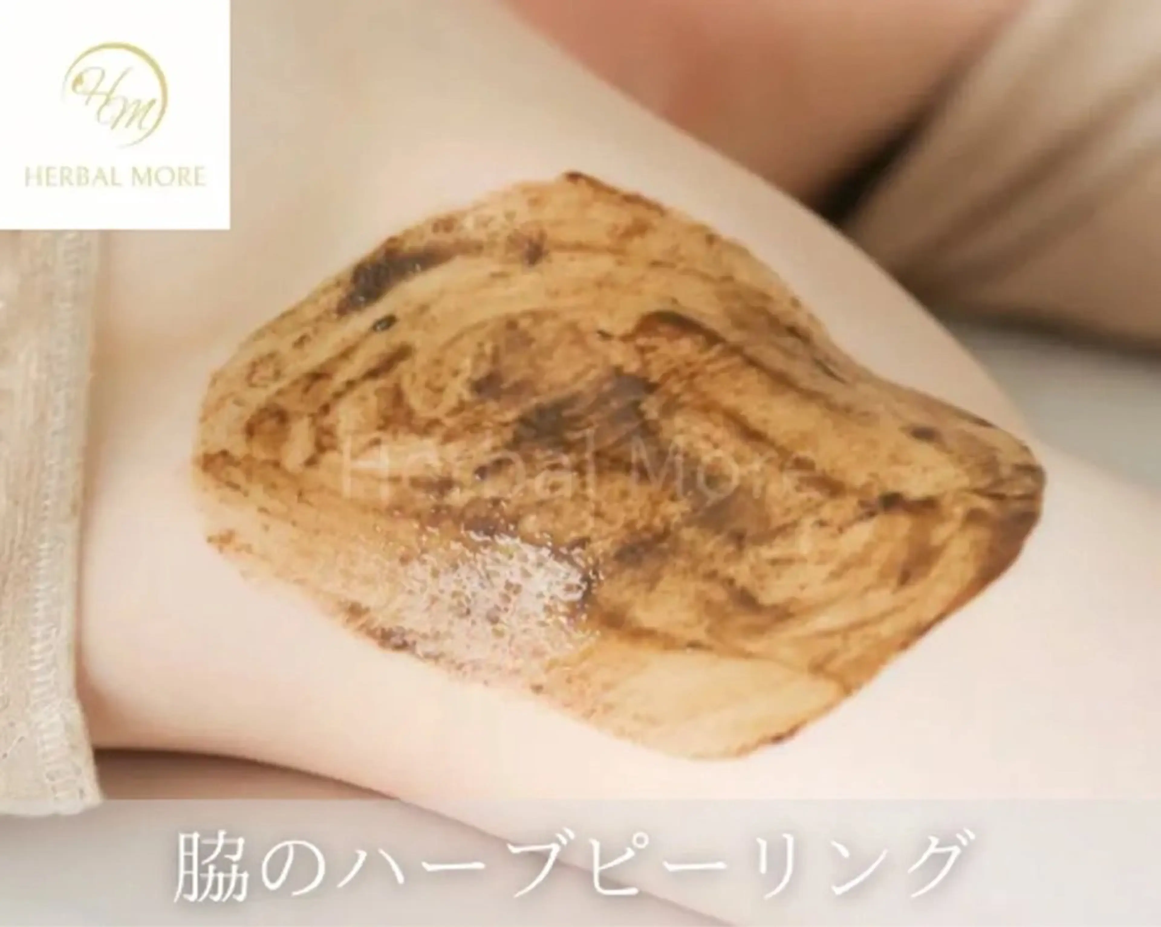 【脇ハーブピーリング/剥離有•無】ニキビケア、色素◯着、毛穴、サメ肌、ニキビあとの写真