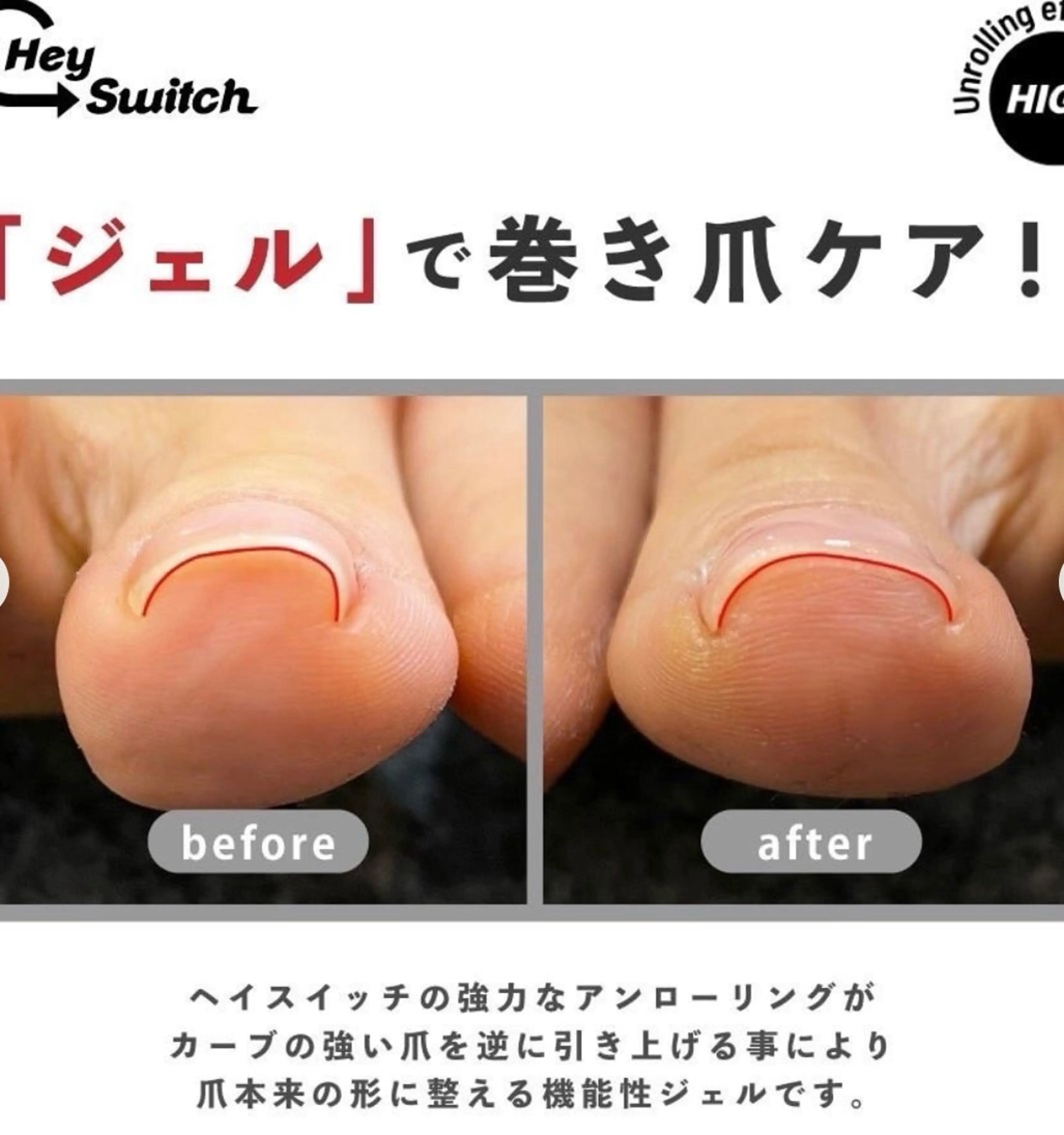 巻き爪ケア特殊ジェルのみのメニュー フットの巻き爪1本の写真