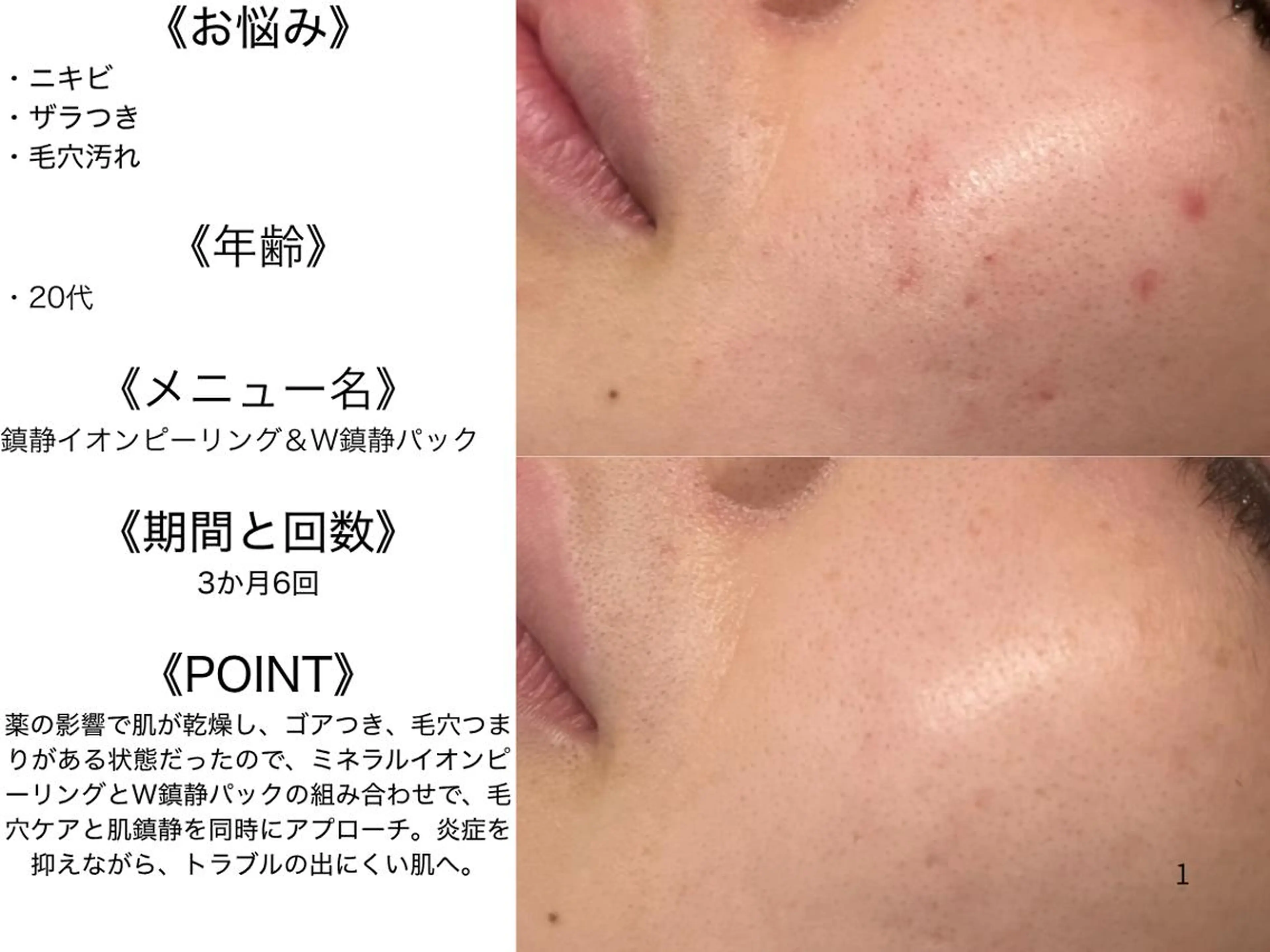 エステ リラク 3か月で肌革命👼 ニキビ専門店💫のエステ・リラクイメージ