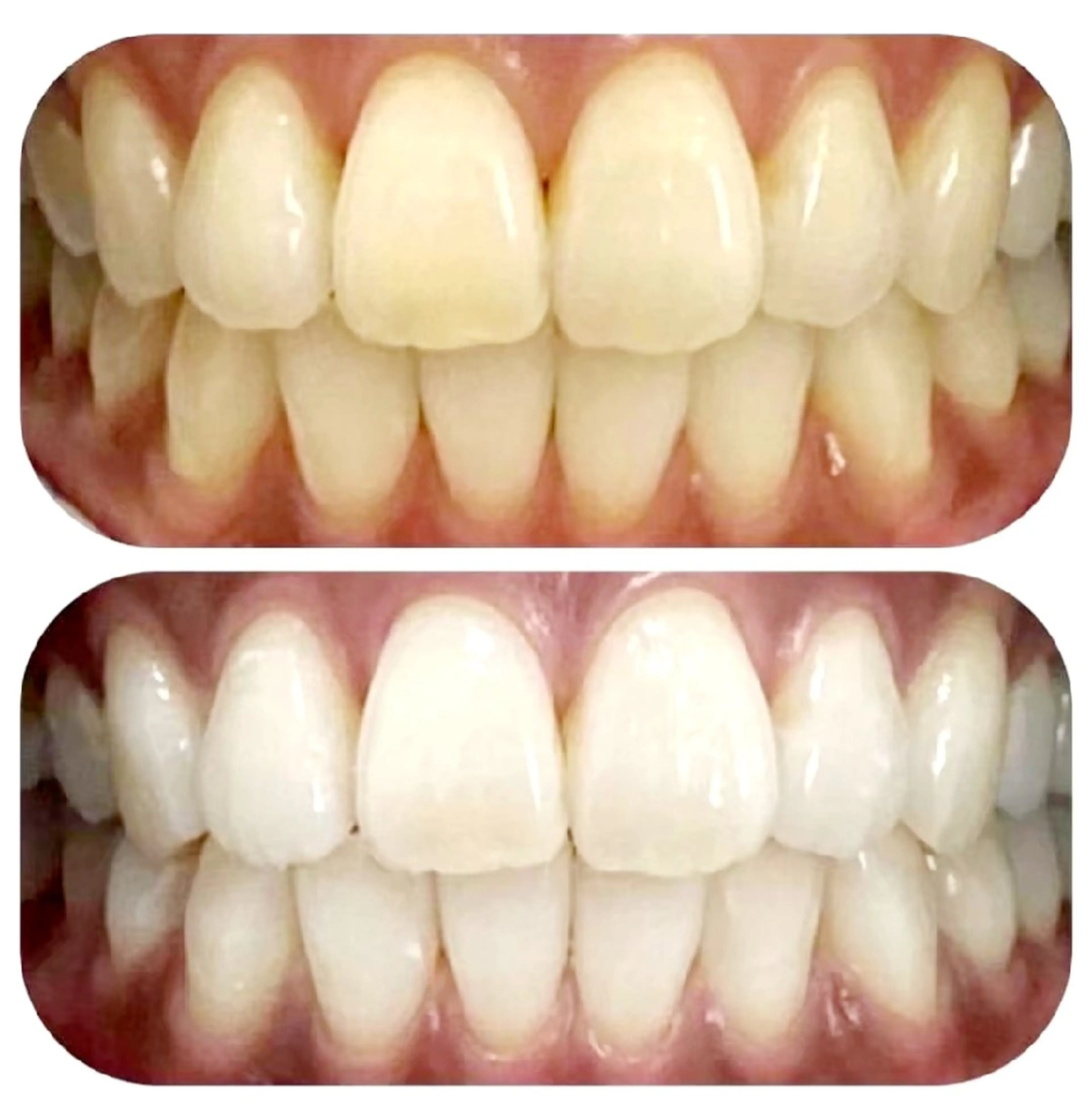 お子様でも痛くない！セルフホワイトニング🦷✨ペア割(お二人様以上でのご来店)  お一人様8分×2セットの写真