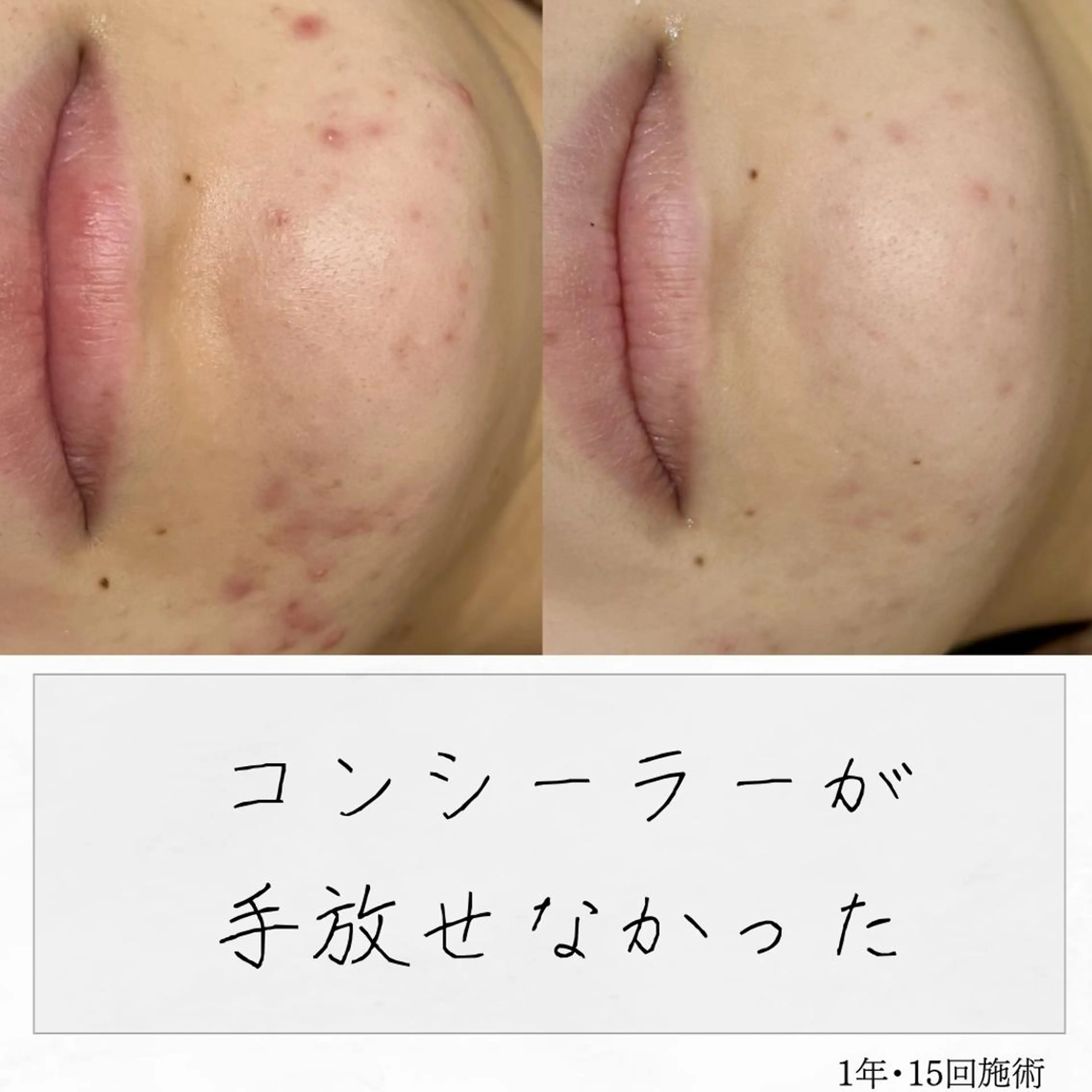 ニキビ経験者が施術 する専門サロン🌻のエステ・リラクイメージ