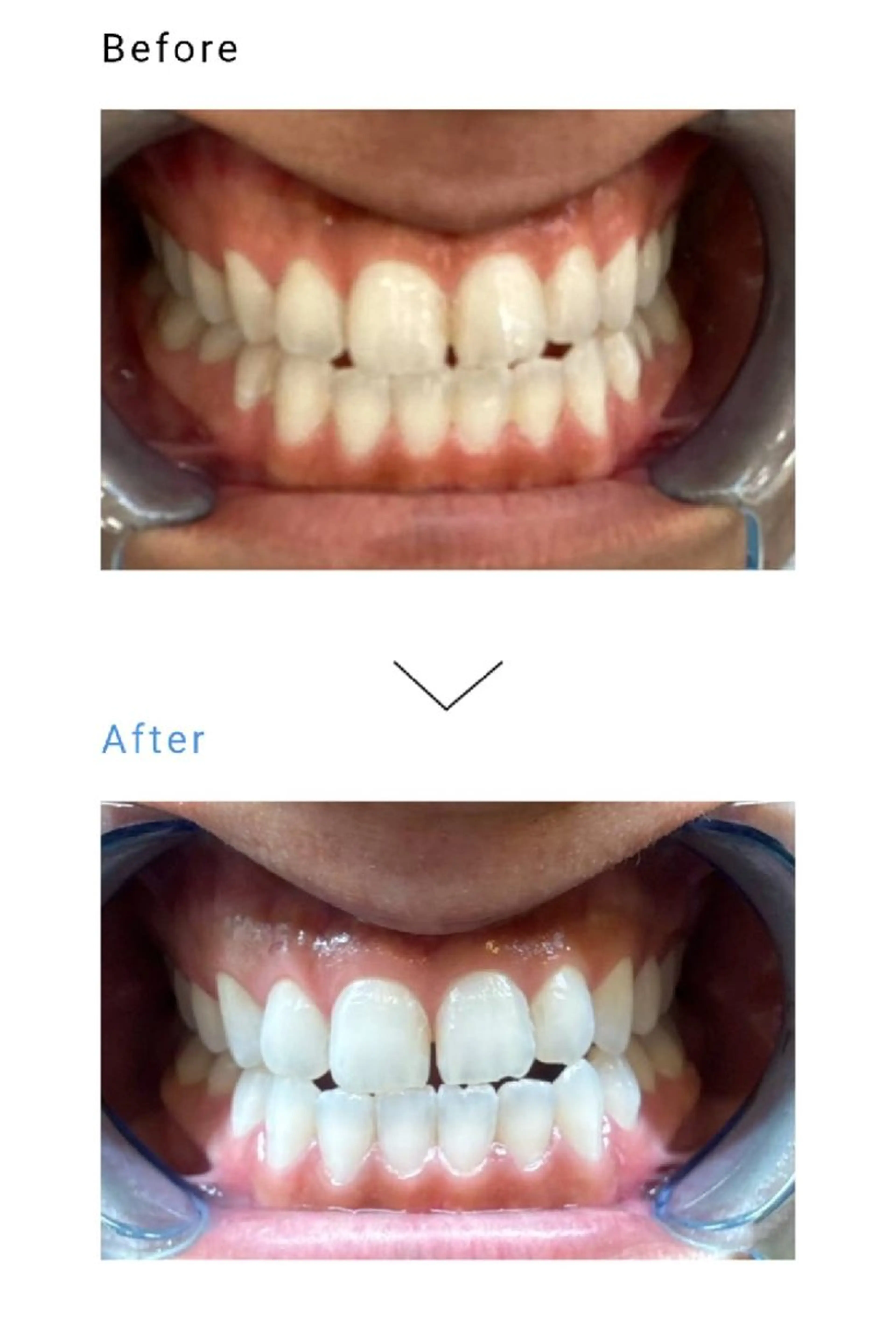 【医療】セルフホワイトニング¥3300(医療診療+¥17500)の写真