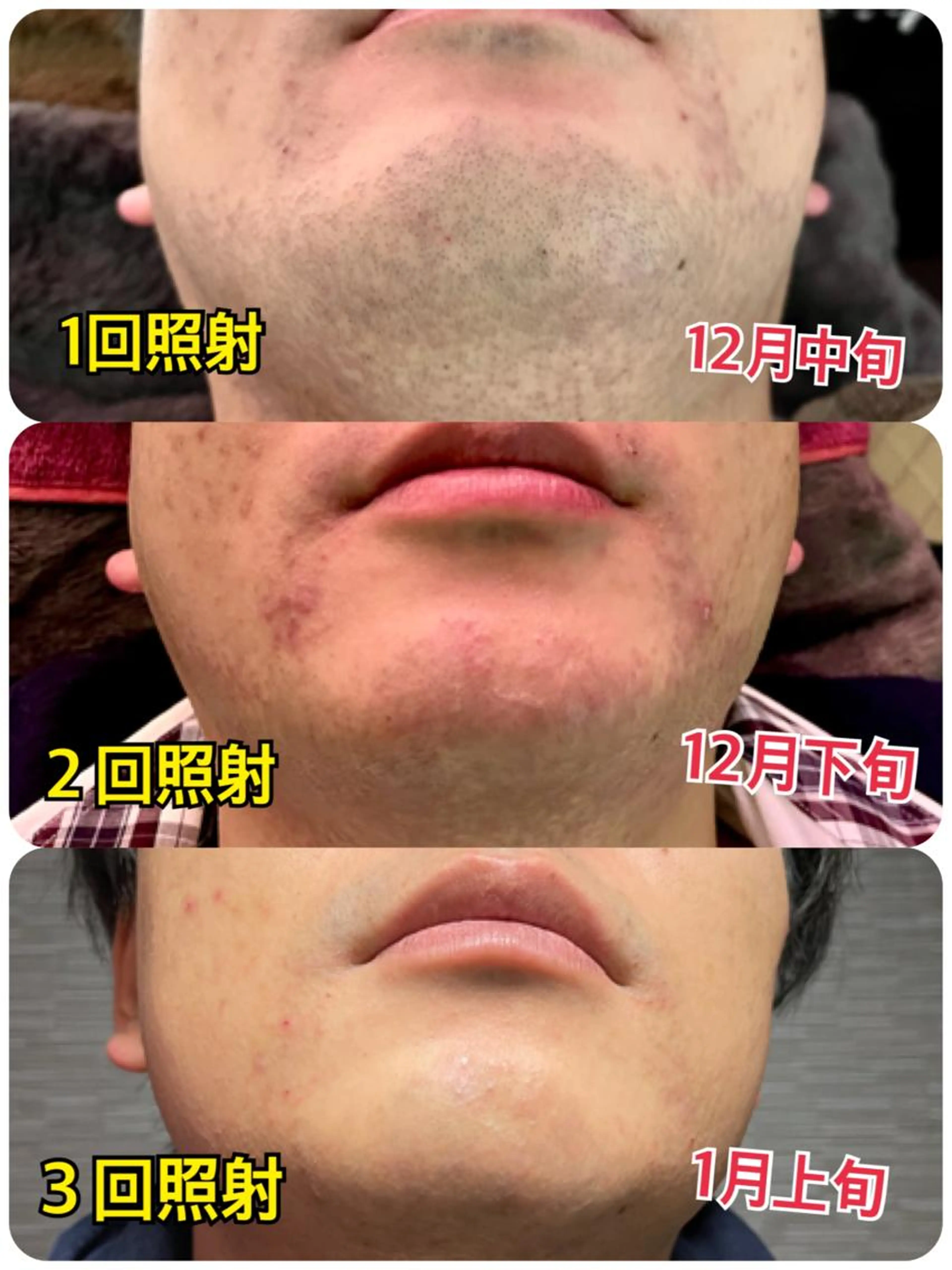 ヒゲ脱毛の写真