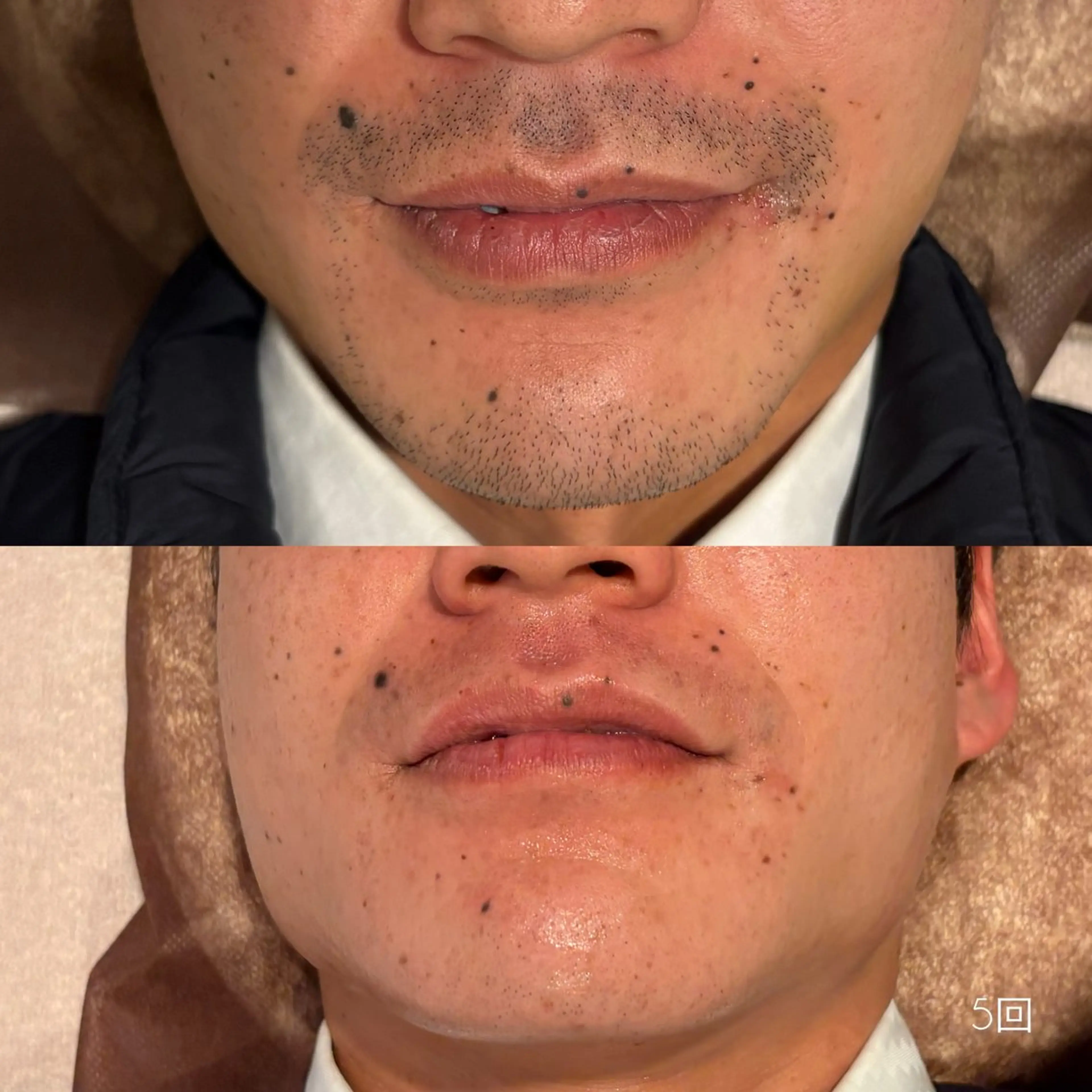 【朝ラク🔥】ヒゲ脱毛!デザイン髭OK/清潔感UP✨の写真