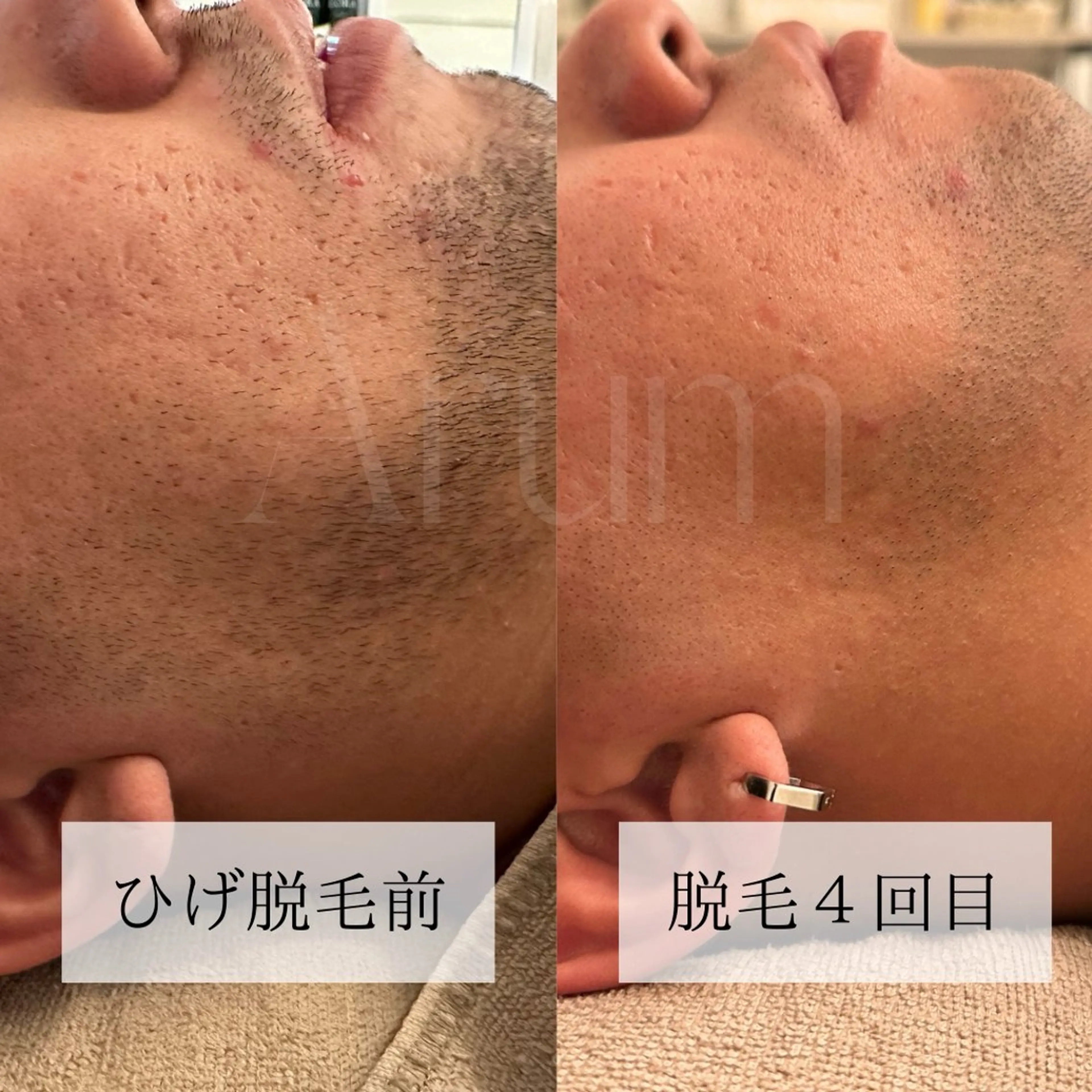 メンズ 脱毛 脱毛サロン Arumのエステ・リラクイメージ