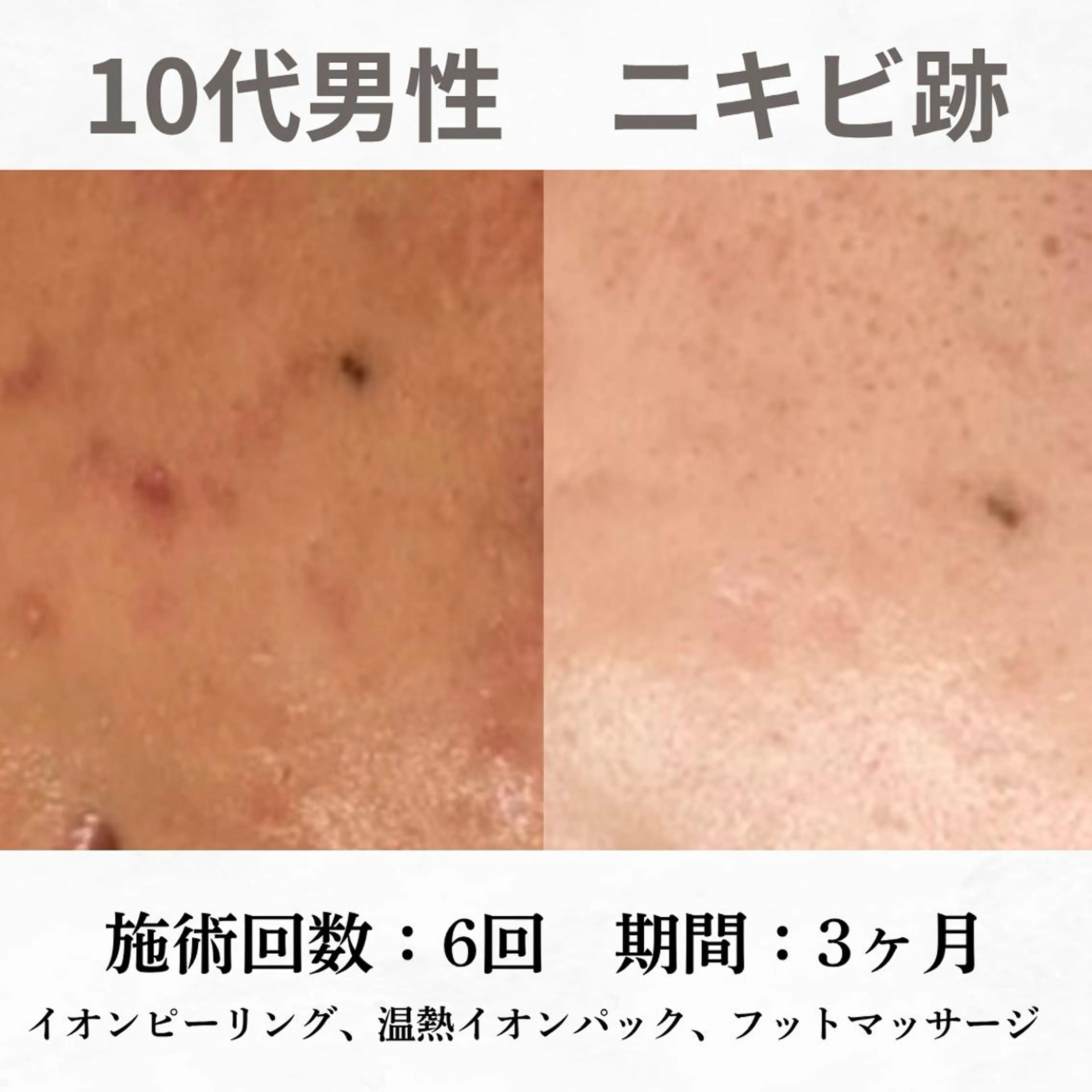 重度ニキビ専門🌷 ダウンタイムなしのエステ・リラクイメージ