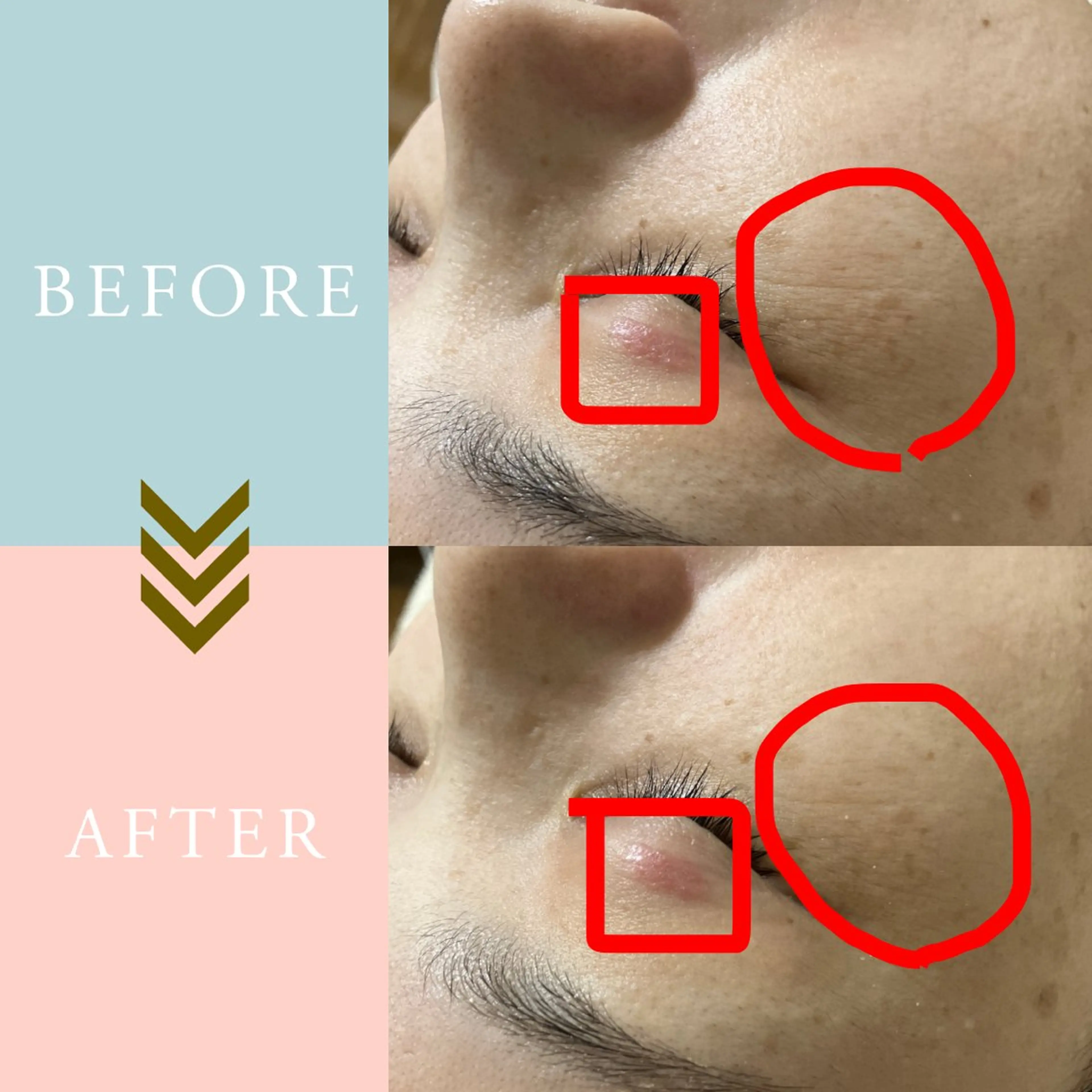 繰り返すニキビ・毛穴 ✨つくば肌質改善専門のエステ・リラクイメージ