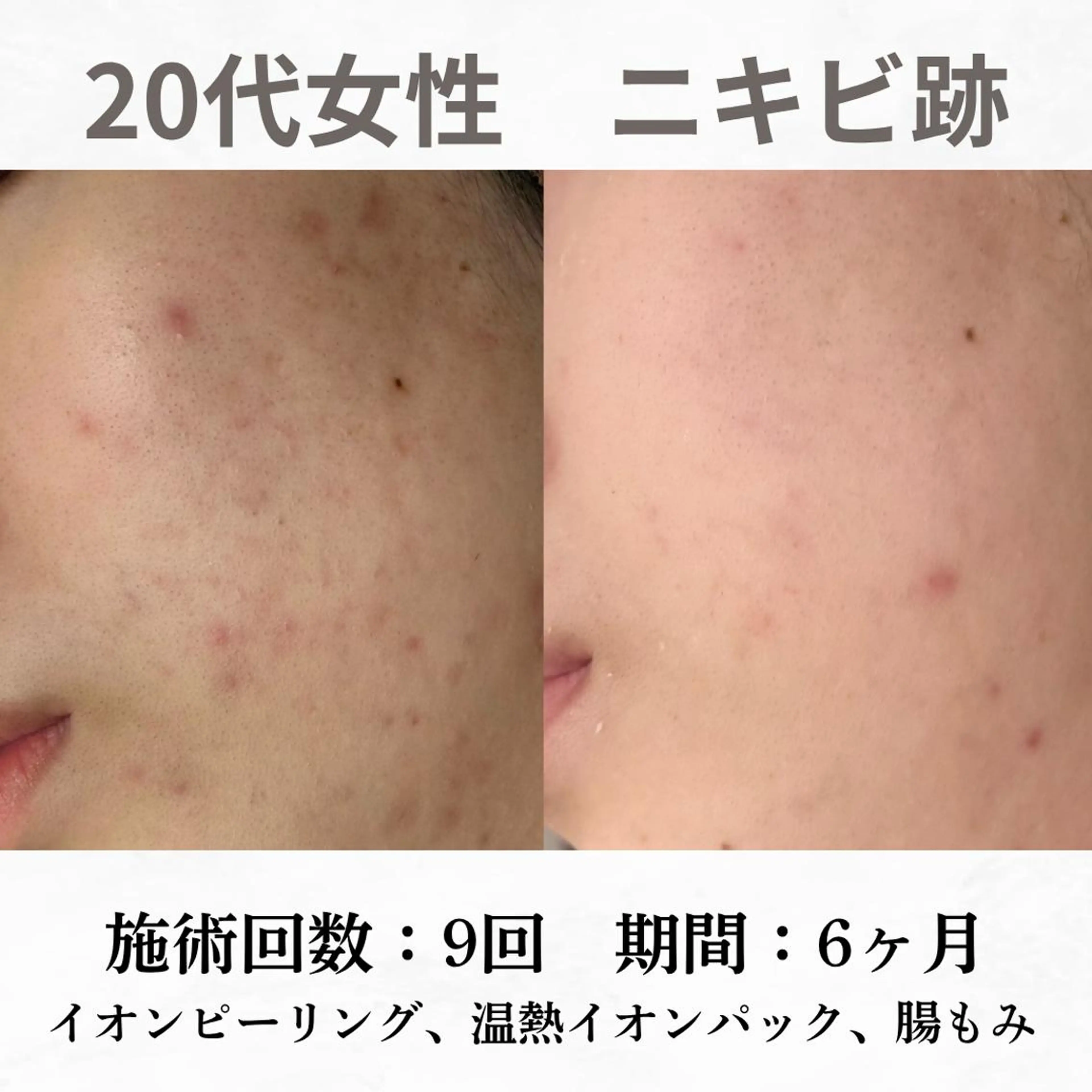 重度ニキビ専門🌷 ダウンタイムなしのエステ・リラクイメージ