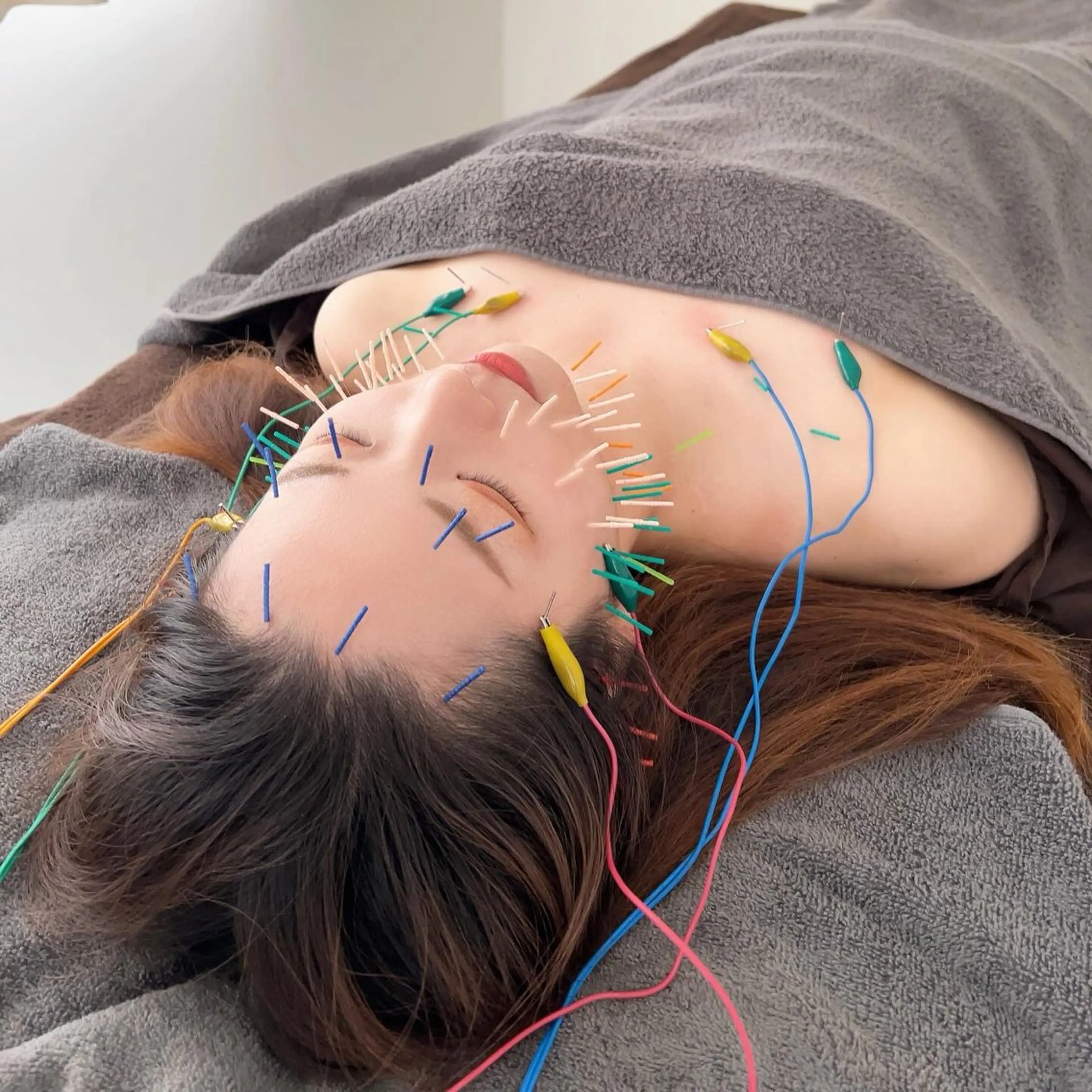 【ミニモ限定価格🩷✨】初回美容鍼の写真