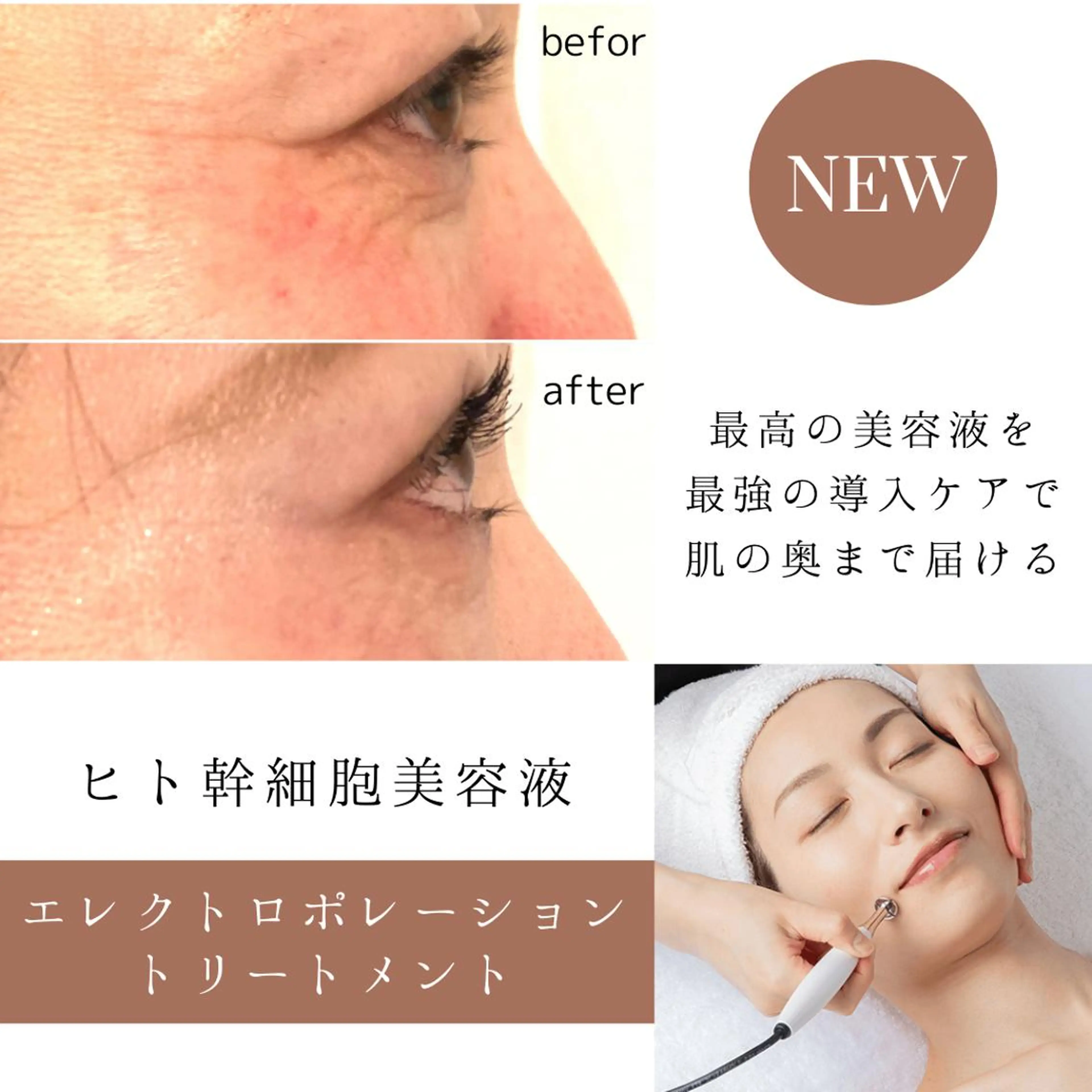 エレクトロポレーション〈ヒト幹細胞上清美容液〉の写真