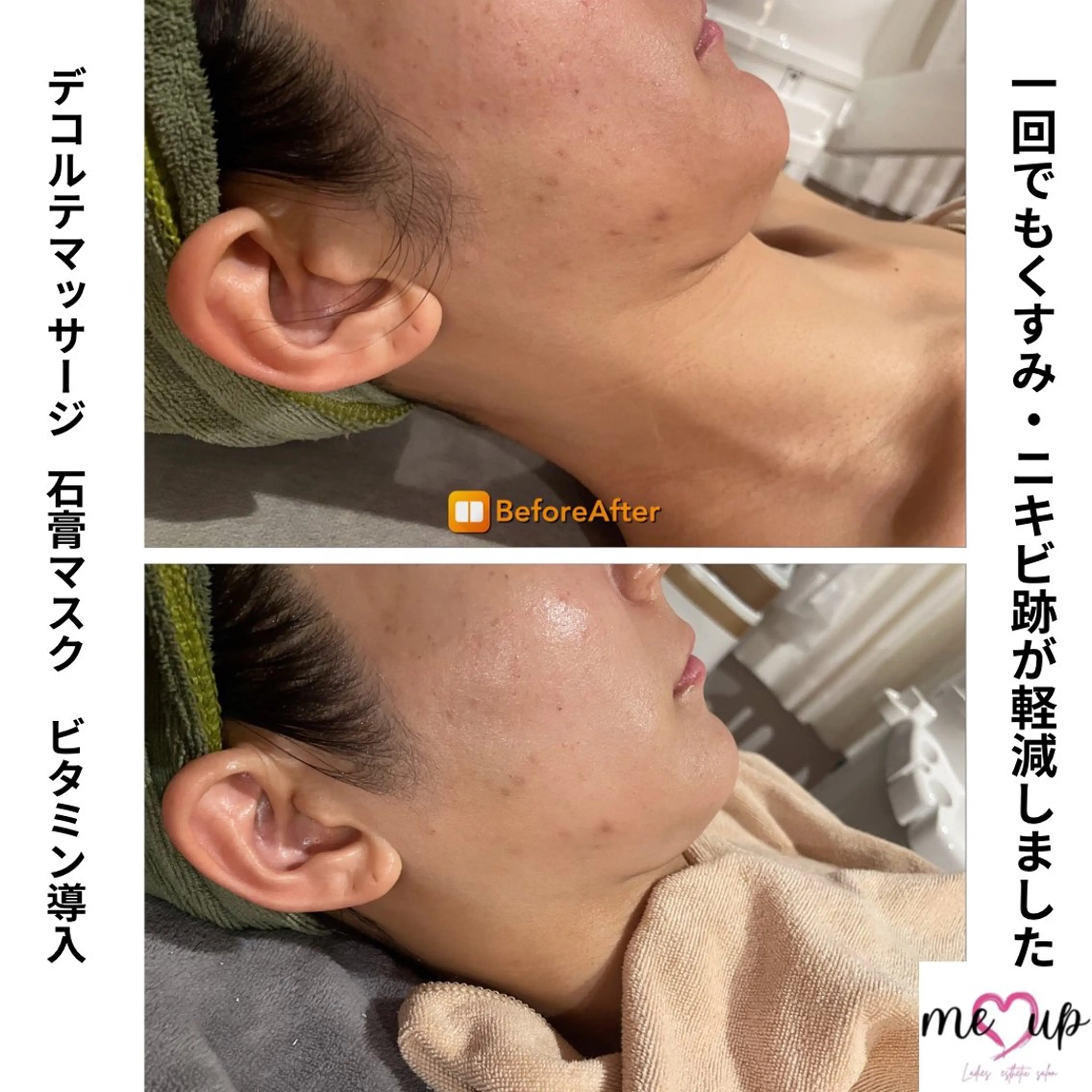 Meupニキビ専門店 背中/ハーブ/肌管理のその他イメージ