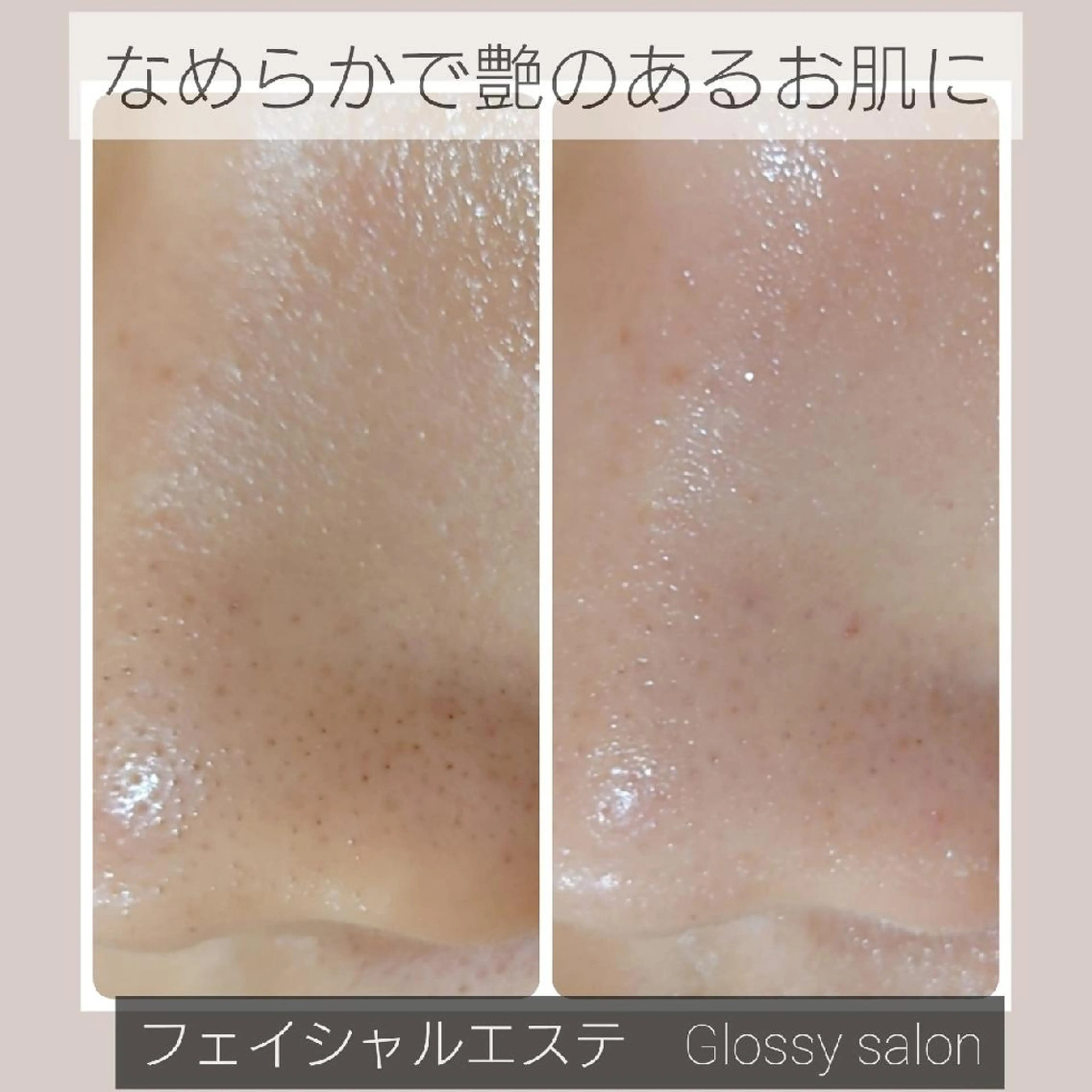 【美小顔術リフト】引き締まった小顔にの写真