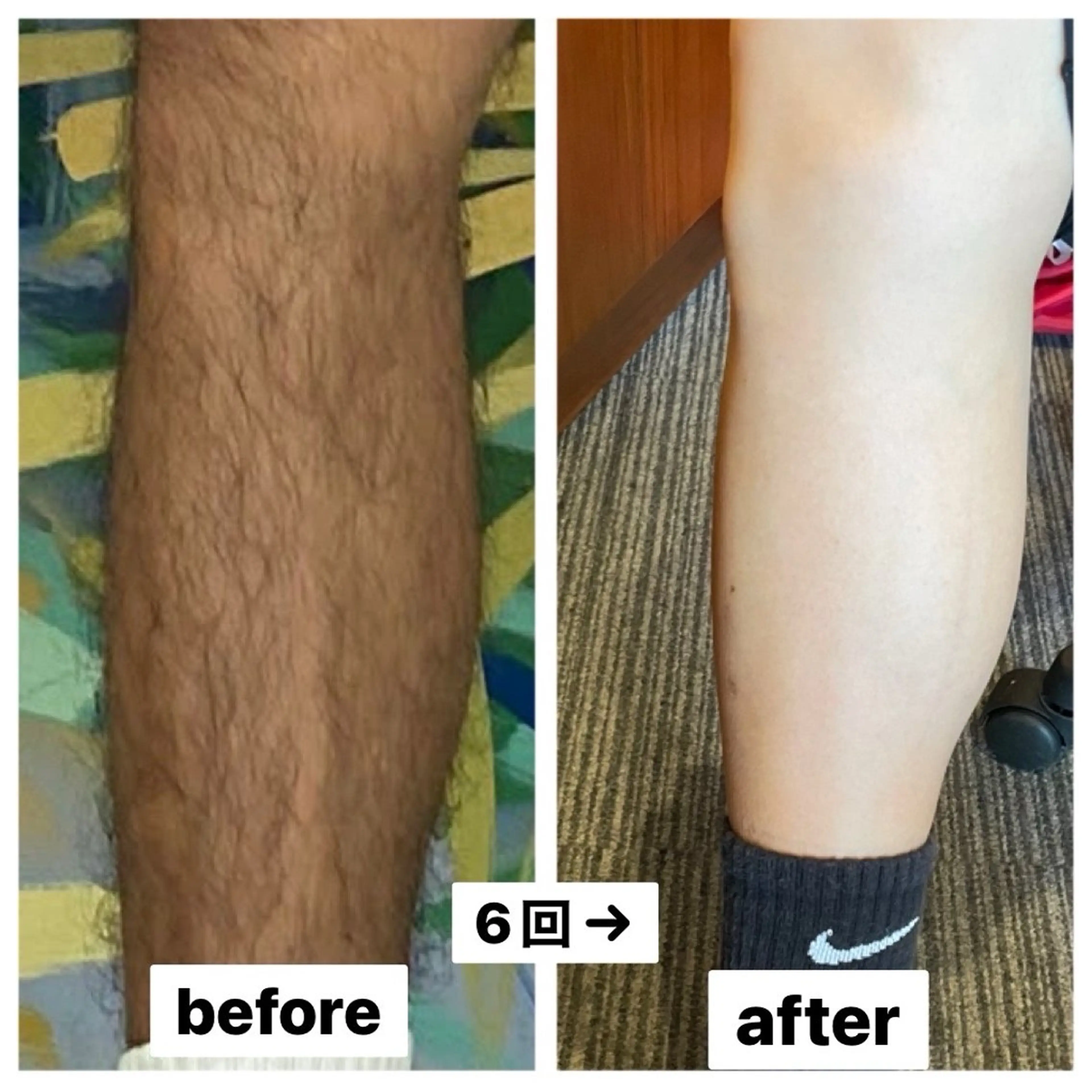 脱毛 渋谷ベルゼ🌷木下 毛穴/脱毛/フェムのその他イメージ