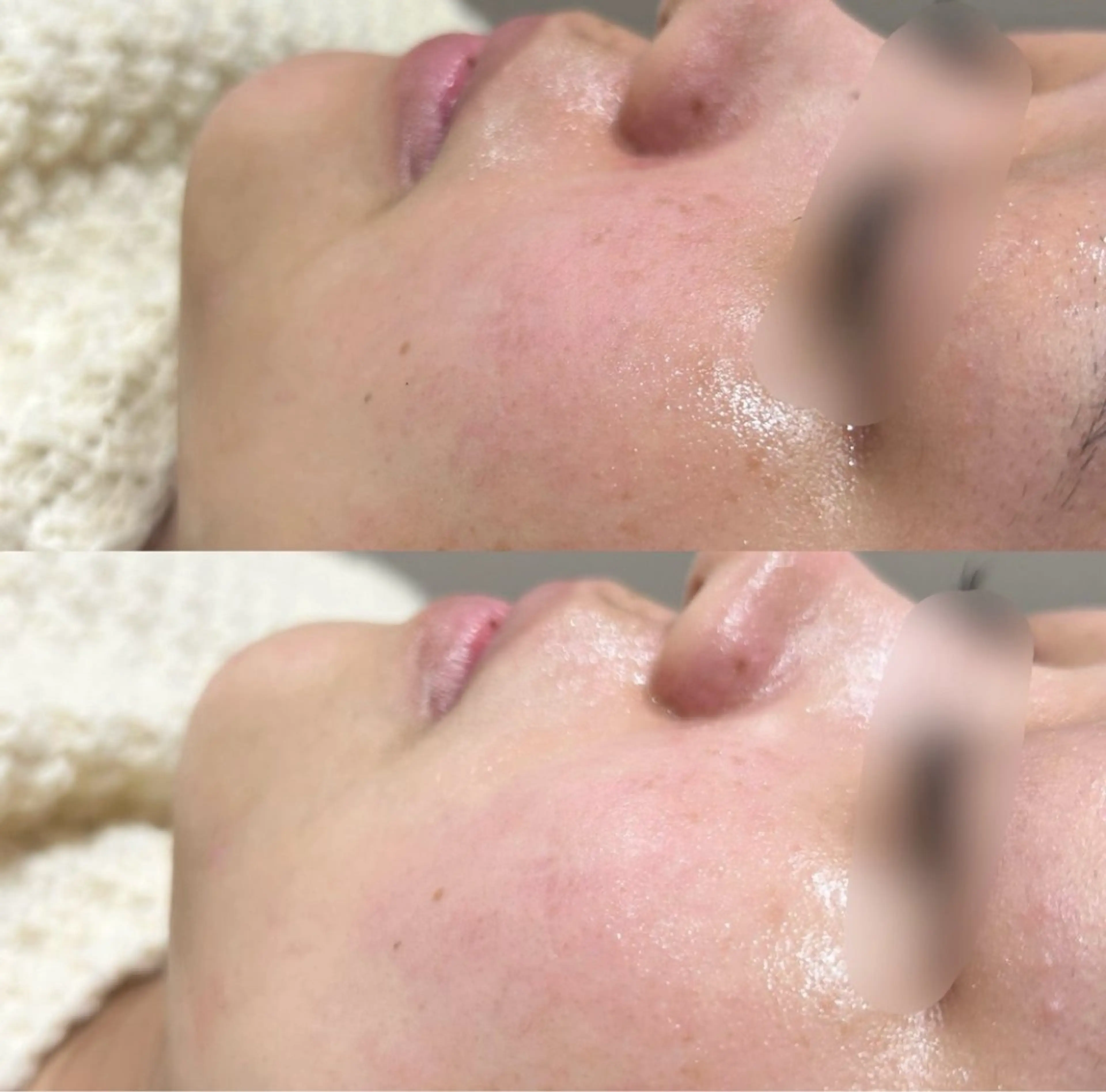 💎✨フェイシャル【人気No.1】✨💎毛穴ピーリング＋光フェイシャル＋美容液導入💖ハリ/ツヤ/くすみ/リフトアップ❕の写真