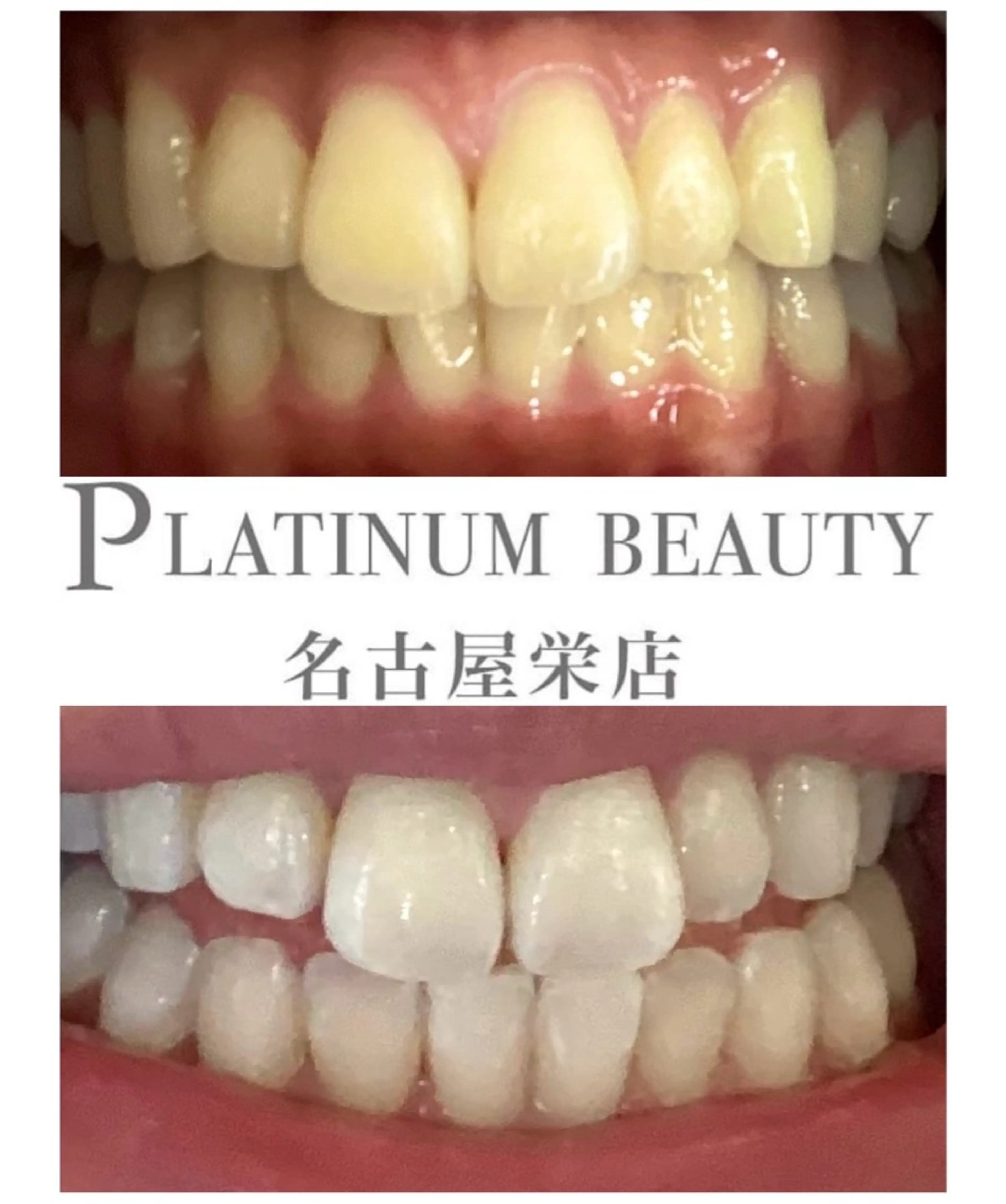 【当店オススメ！本気で白くしたい方へ】　プレミアムセルフホワイトニング✨〈2来店合計70分〉の写真