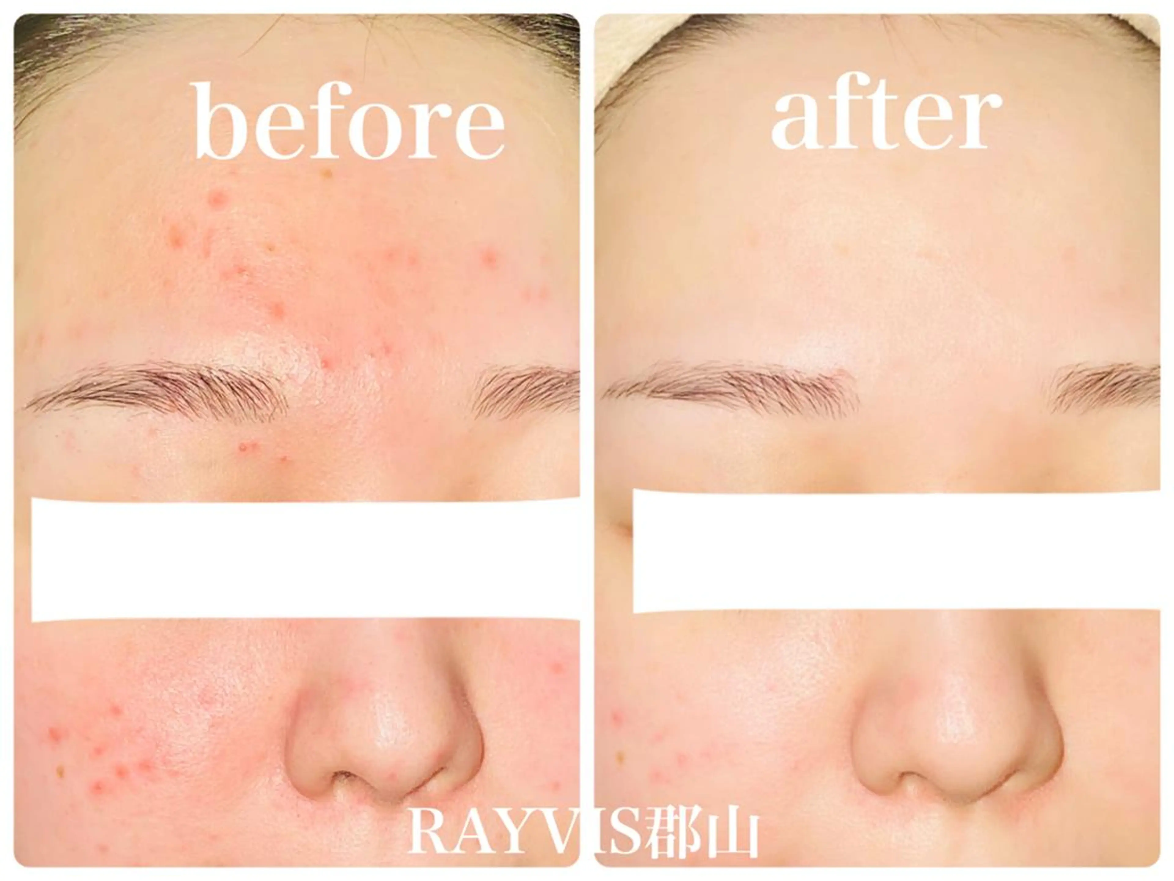 🔅平日限定🔅美白＋小顔＋毛穴レスで憧れのノーファンデ肌✨目指せ赤ちゃん肌の写真