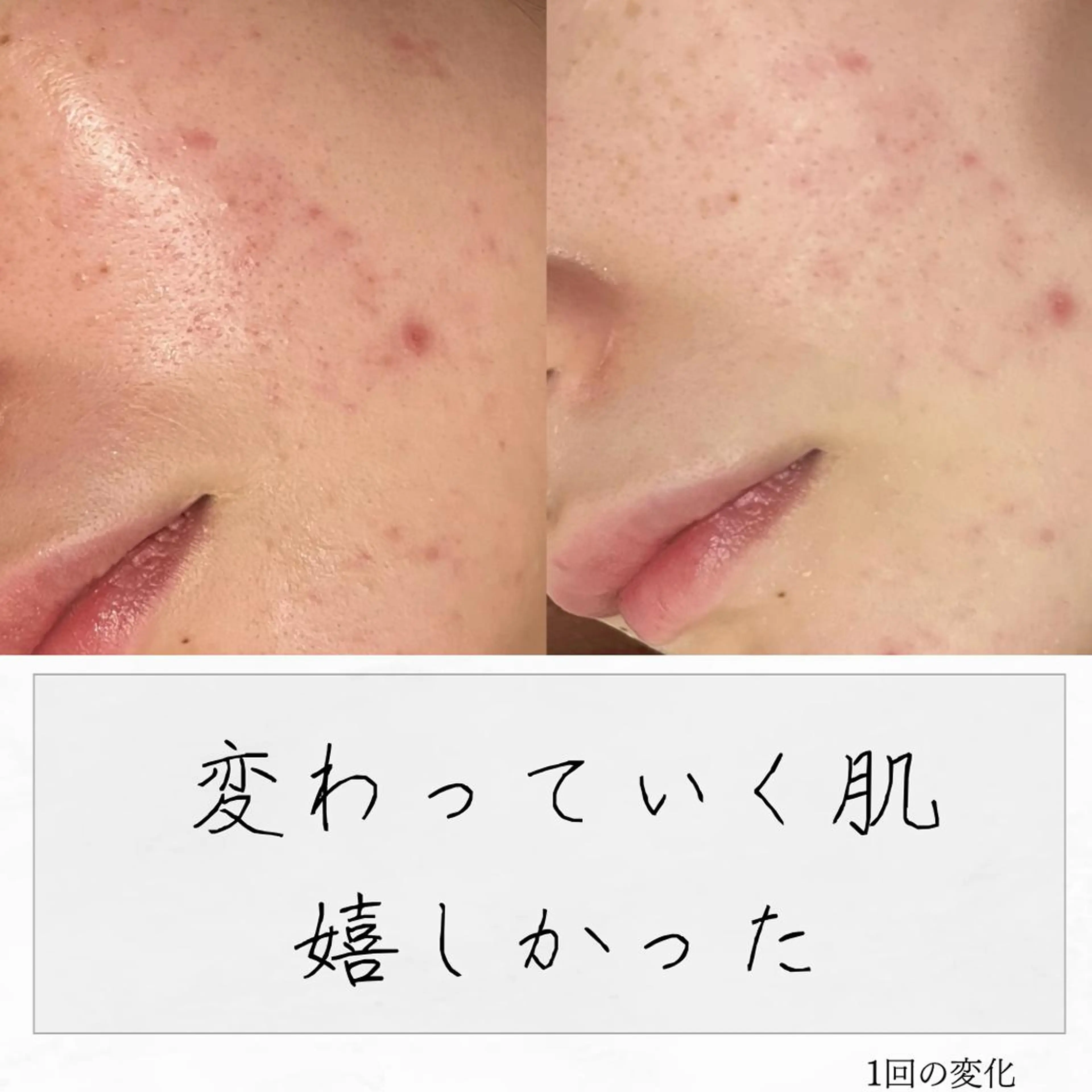 ニキビ経験者が施術 する専門サロン🌻のエステ・リラクイメージ