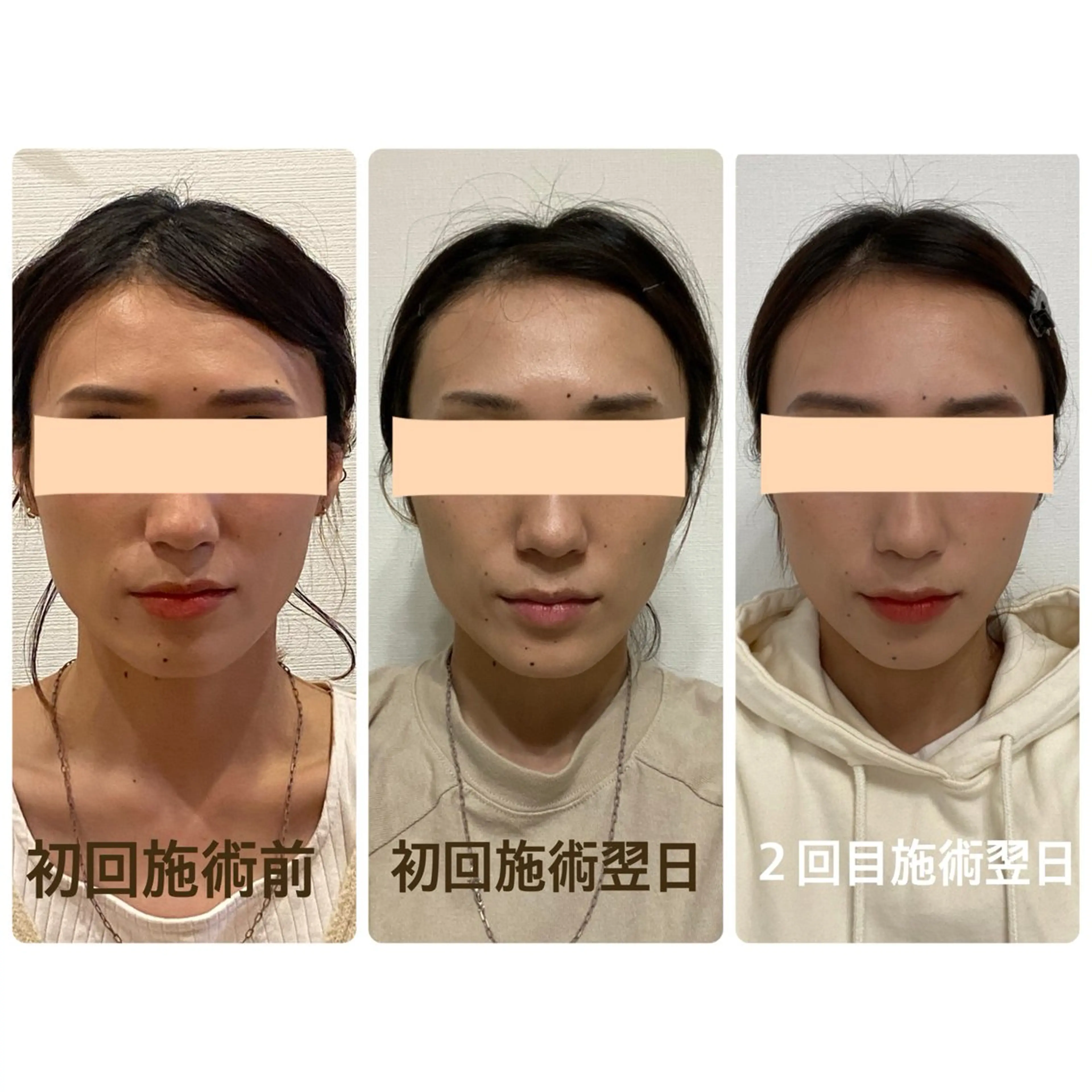 小顔矯正の写真