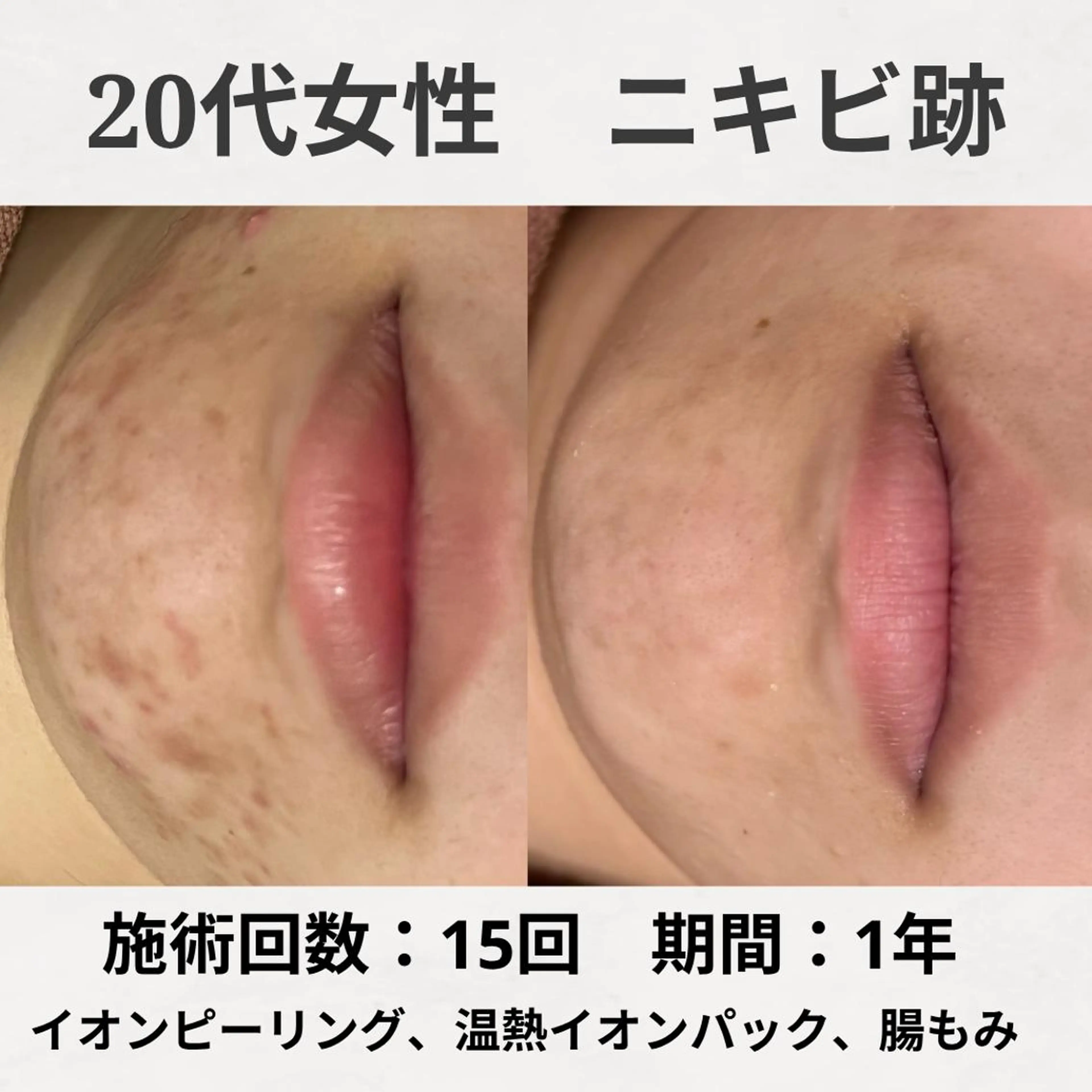 エステ リラク ニキビ跡改善専門🔥 医療にはできない改善のエステ・リラクイメージ