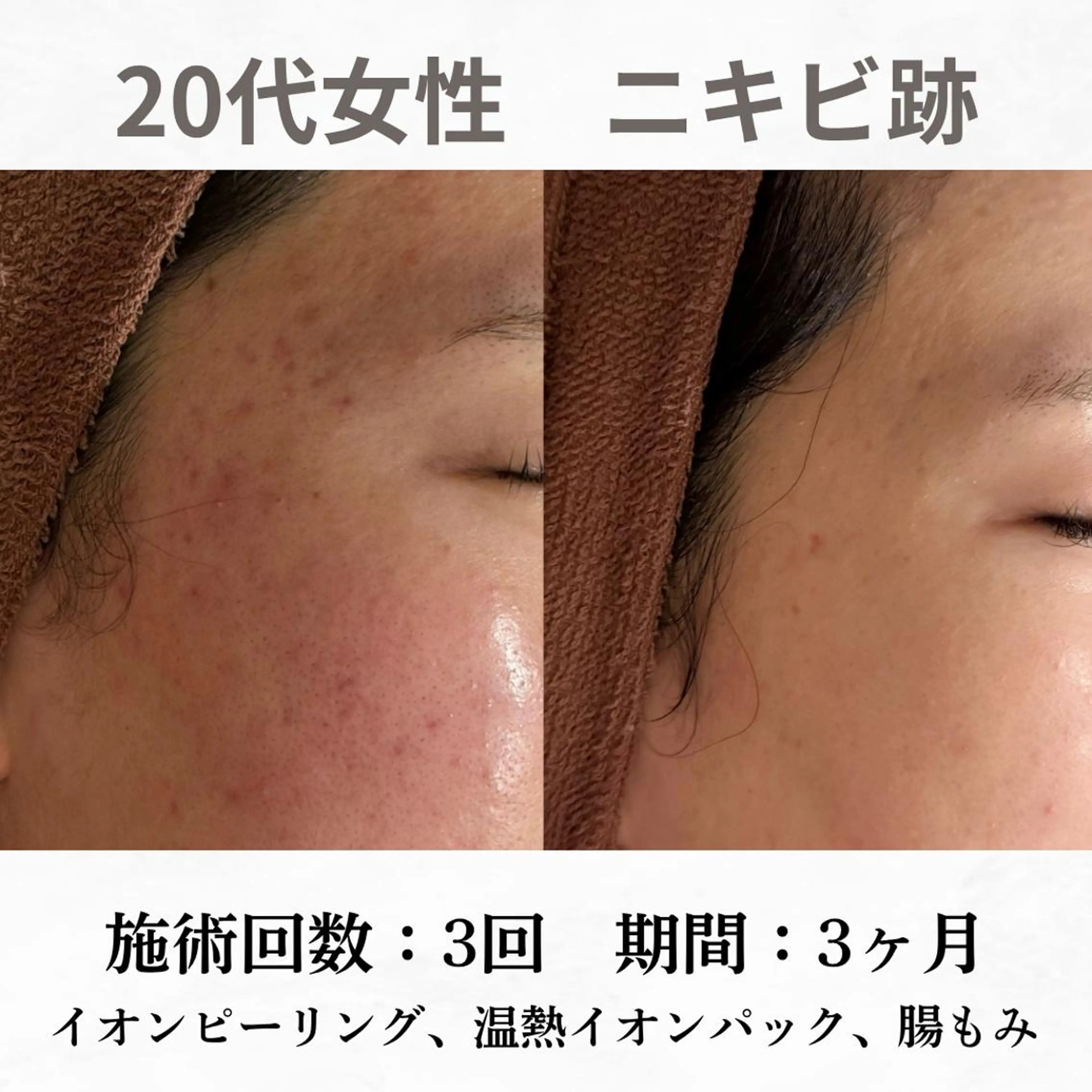 重度ニキビ専門🌷 ダウンタイムなしのエステ・リラクイメージ