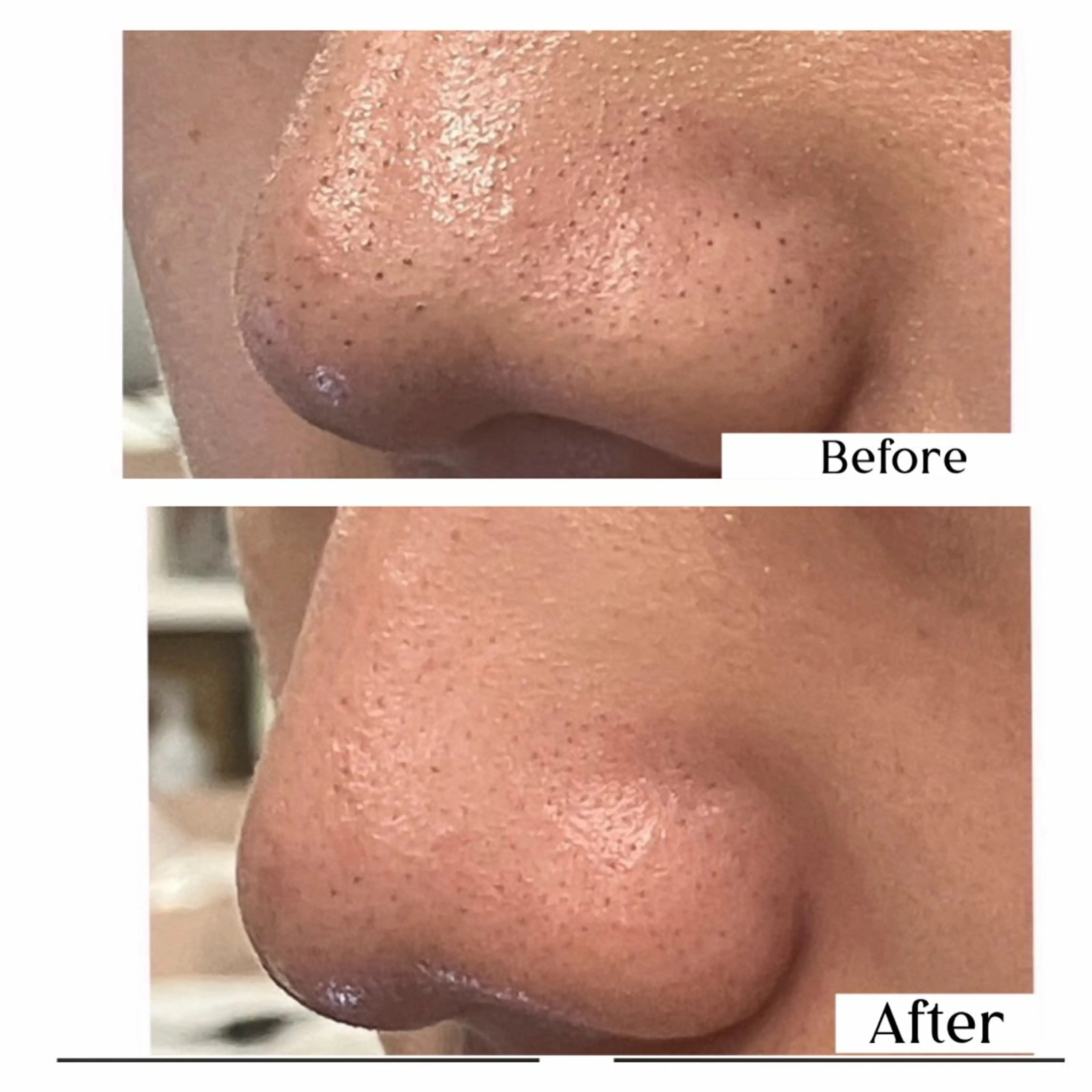 毛穴洗浄フェイシャル✨全顔の毛穴の汚れをピカピカにの写真