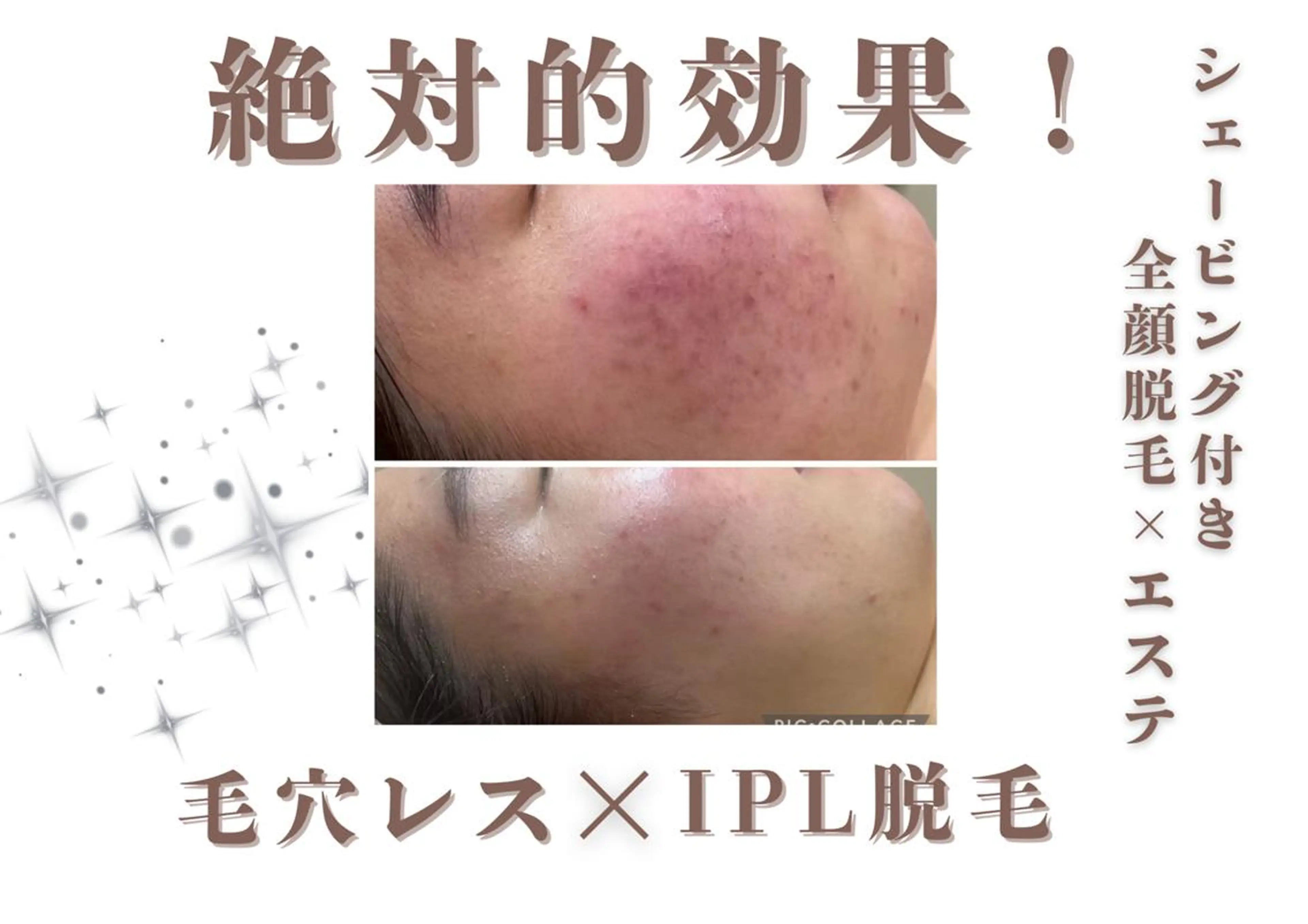 脱毛 🐶レイビス 銀座店🐶simaのエステ・リラクイメージ
