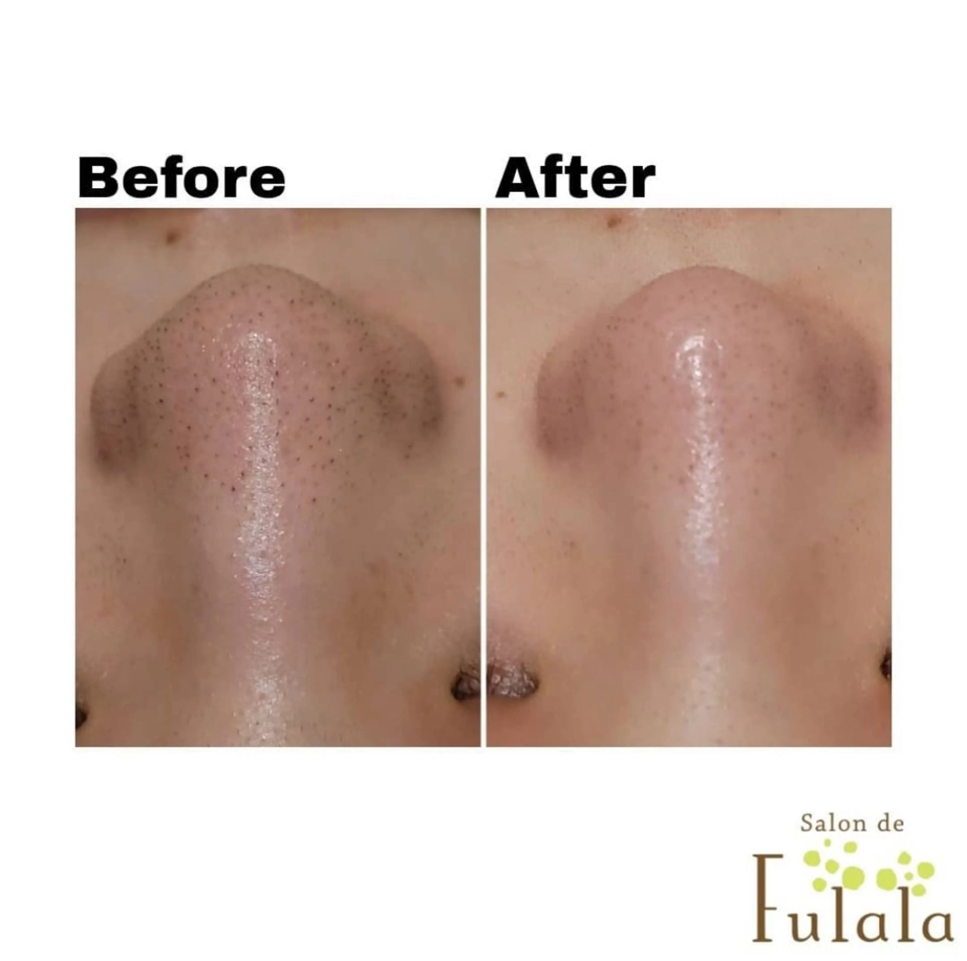 【4月✨ご新規様限定】毛穴の角栓ごっそり撃退コース ¥13,200→¥3,980の写真