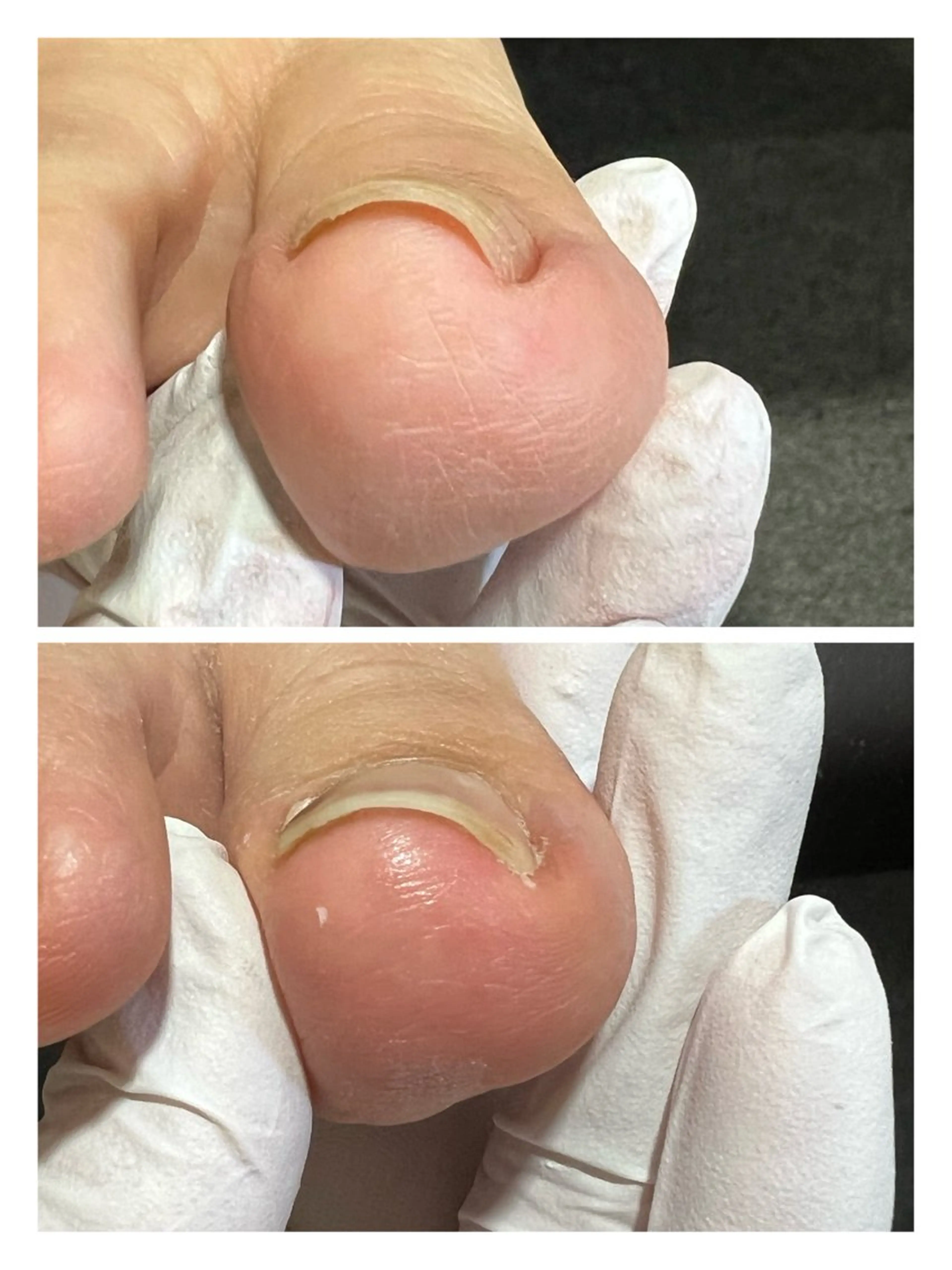 ⭐️ご新規様限定⭐️ 巻き爪【中度】¥6,600※初診料別途の写真