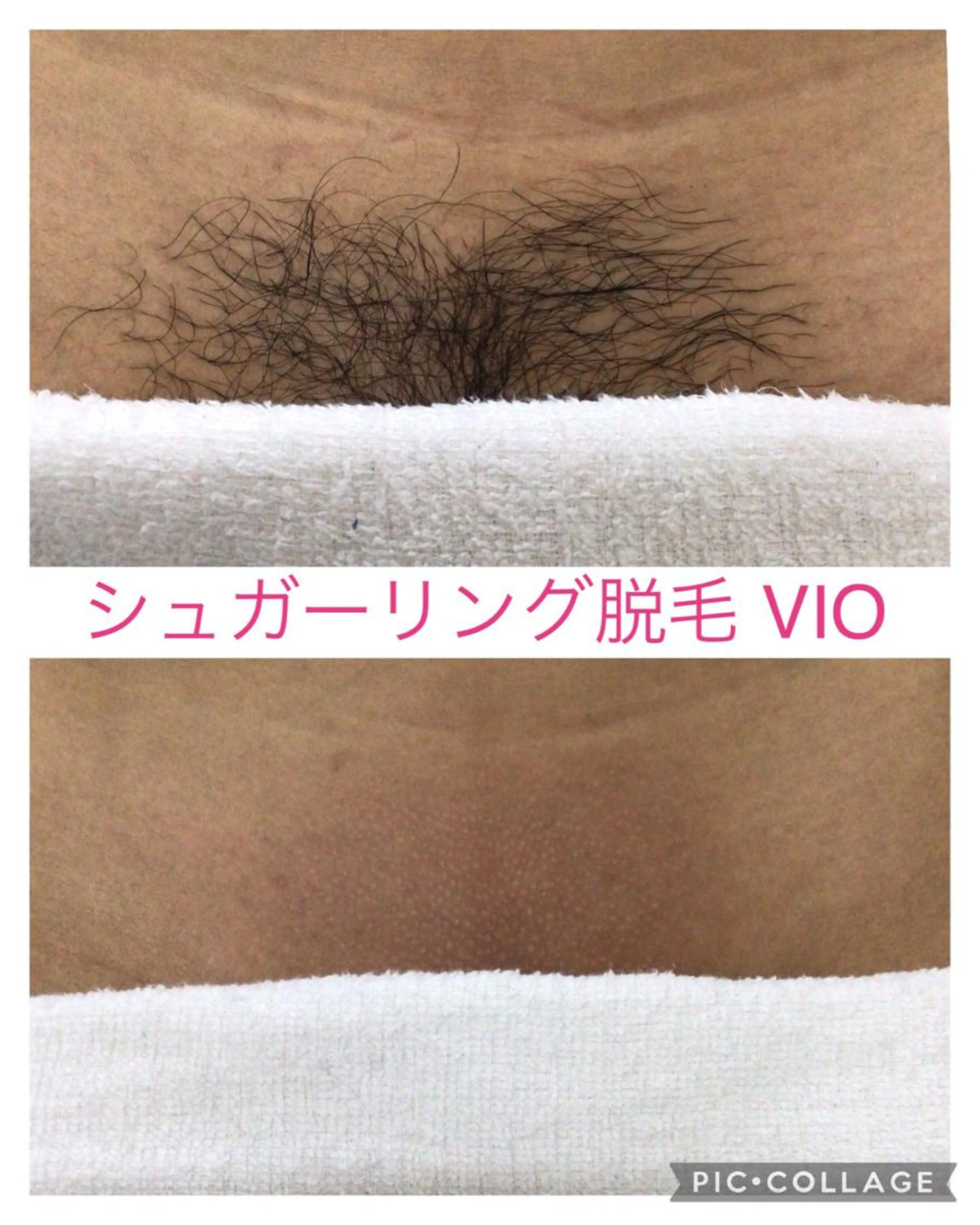 【４月来店限定🌸】VIO シュガーリング脱毛の写真
